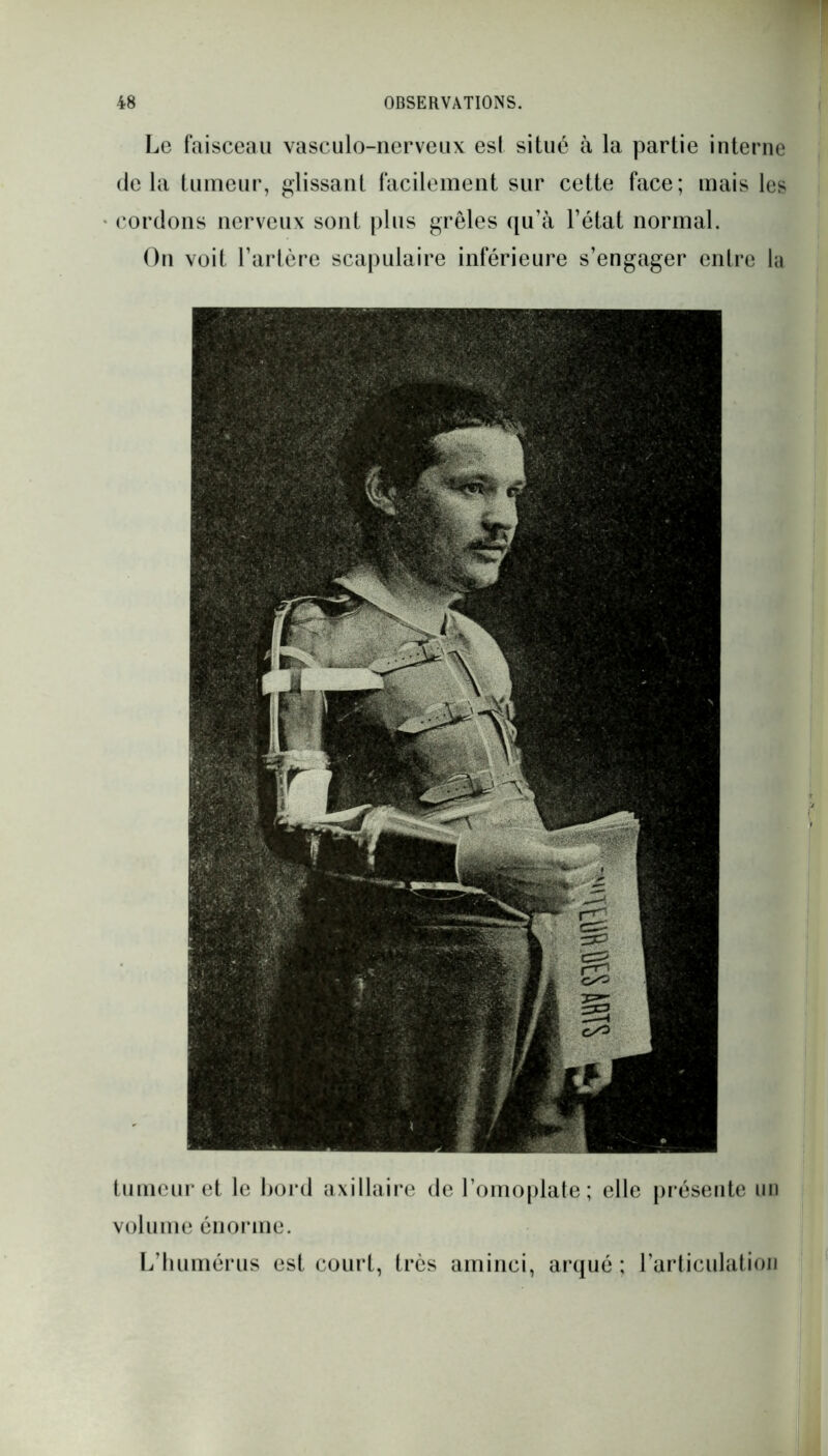 Le faisceau vasculo-nerveux est situé à la partie interne delà tumeur, glissant facilement sur cette face; mais les cordons nerveux sont plus grêles qu’à l’état normal. On voit l’artère scapulaire inférieure s’engager entre la tumeur et le bord axillaire de l’omoplate; elle présente un volume énorme. L’humérus est court, très aminci, arqué; l’articulation