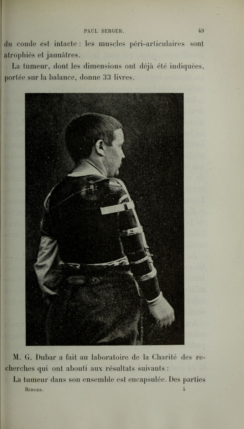 M. G. Dubar a fait au laboratoire de la Charité des re- cherches qui ont abouti aux résultats suivants : La tumeur dans son ensemble est encapsulée. Des parties Berger. du coude est intacte : les muscles péri-arliculaires sont atrophiés et jaunâtres. La tumeur, dont les dimensions ont déjà été indiquées, portée sur la balance, donne 33 livres. 4
