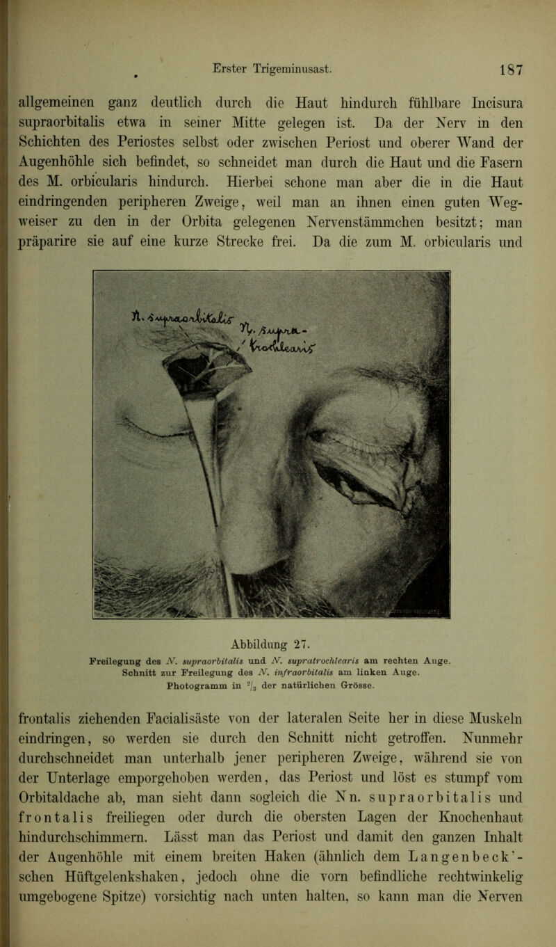 allgemeinen ganz deutlich durch die Haut hindurch fühlbare Incisura supraorbitalis etwa in semer Mitte gelegen ist. Da der Nerv in den Schicbten des Périostes selbst oder zwischen Periost und obérer Wand der Augenhôble sich befindet, so schneidet man dnrch die Haut und die Fasern des M. orbicularis bindurcb. Hierbei schone man aber die in die Haut eindringenden peripheren Zweige, weil man an ihnen einen guten Weg- weiser zu den in der Orbita gelegenen Nervenstàmmchen besitzt; man prâparire sie auf eine kurze Strecke frei. Da die zum M. orbicularis und Abbildung 27. Freilegung des N, supraorbitalis und N. supratrochlearis am rechten Auge. Schnitt zur Freilegung des N. infraorbitalis am linken Auge. Photogramm in 2/s der natürlichen Grôsse. frontalis ziebenden Facialisâste von der lateralen Seite her in diese Muskeln eindringen, so werden sie durch den Schnitt nicht getroffen. Nunmehr durchschneidet man unterbalb jener peripheren Zweige, wâhrend sie von der Unterlage emporgehoben werden, das Periost und lôst es stumpf vom Orbitaldache ab, man sieht dann sogleich die Nn. supraorbitalis und frontalis freiliegen oder durch die obersten Lagen der Knochenhaut hindurchschimmern. Lâsst man das Periost und damit den ganzen Inhalt der Augenhohle mit einem breiten Haken (âhnlich dem Lange nbeck’- schen Hüftgelenksbaken, jedoch ohne die vorn befindliche rechtwinkelig umgebogene Spitze) vorsichtig nach unten halten, so kann man die Herven