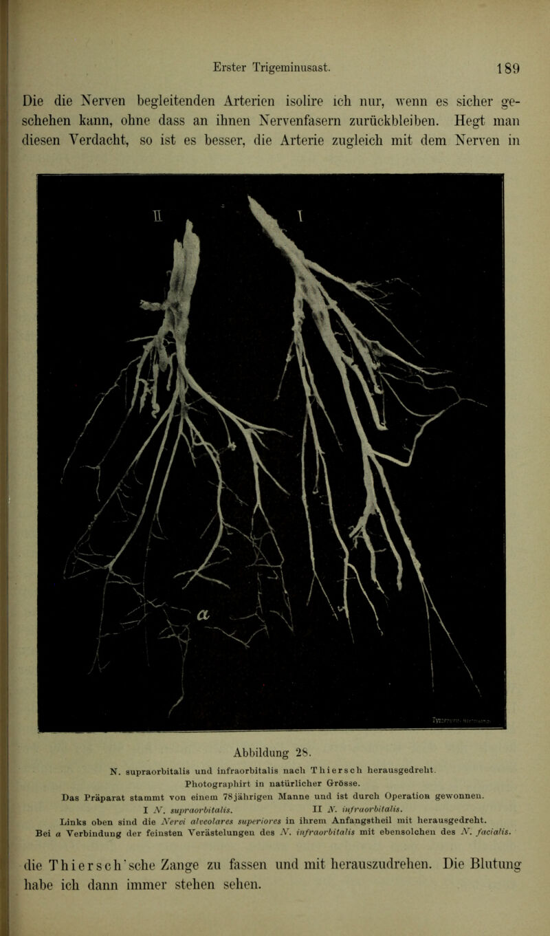 Die die Nerven begleitenden Arterien isolire ich nur, wenn es sicher ge- schehen kann, ohne dass an ihnen Nervenfasern zurückbleiben. Hegt man diesen Yerdacht, so ist es besser, die Arterie zugleich mit dem Nerven in Abbildung 28. N. supraorbitalis und infraorbitalis nach T hier s ch herausgedreht. Photographirt in natürlicher G-rôsse. Das Pràparat stammt von einem 78jâhrigen Manne und ist durch Operation gewonnen. I N. supraorbitalis. II N. infraorbitalis. Links oben sind die Nervi alveolares superiores in ihrem Anfangstheil mit herausgedreht. Bei a Yerbindung der feinsten Verastelungen des N. infraorbitalis mit ebensolchen des N. facialis. die Thier sch'sche Zange zu fassen und mit herauszudrehen. Die Blutung habe ich dann immer stehen sehen.