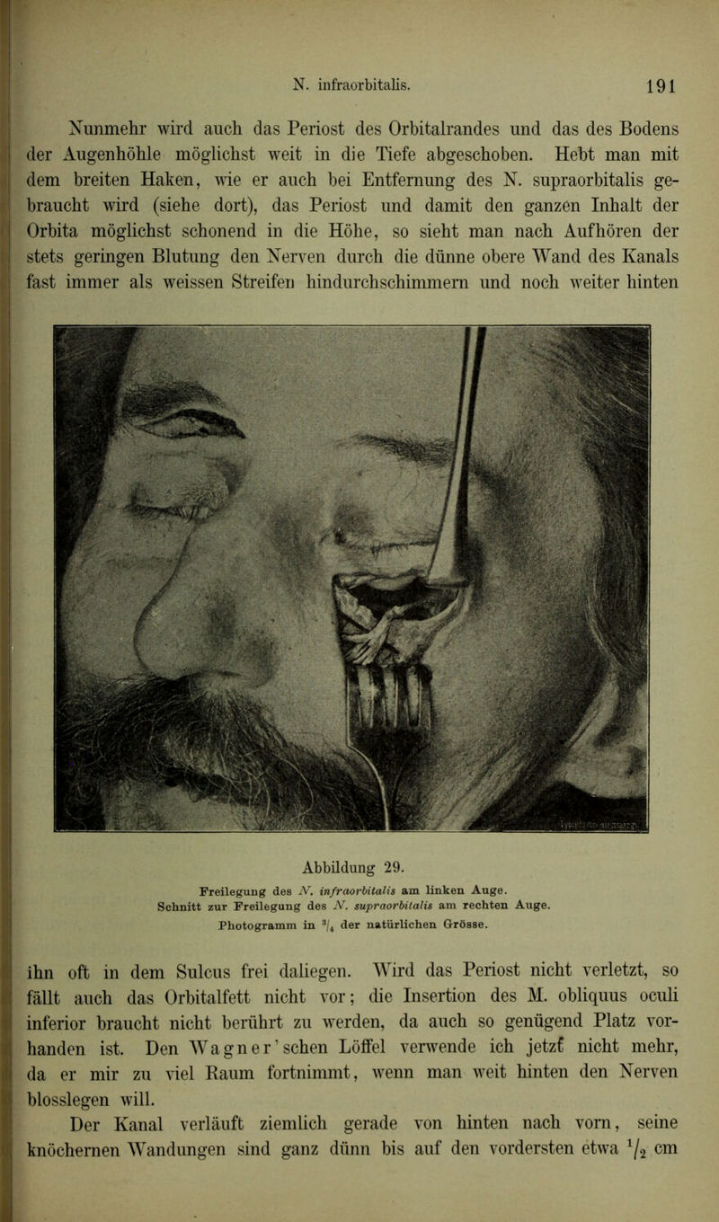 ! ! Nunmehr wird anch das Periost des Orbitalrandes und das des Bodens der Augenhohle mogiichst weit in die Tiefe abgeschoben. Hebt man mit dem breiten Haken, wie er auch bei Entfemung des N. snpraorbitalis ge- braucht wird (siehe dort), das Periost und damit den ganzen Inhalt der Orbita mogiichst schonend in die Hôhe, so sieht man nach Aufhôren der stets geringen Blutung den Nerven durch die dünne obéré Wand des Kanals fast immer als weissen Streifen hindurchschimmern und noch weiter hinten Abbildung 29. Freilegung des N. infraorbitalis am linken Auge. Schnitt zur Freilegung des N. supraorbitalis am rechten Auge. Photogramm in ®/4 der natürlichen Grosse. ihn oft in dem Sulcus frei daliegen. Wird das Periost nicht verletzt, so | fàllt auch das Orbitalfett nicht vor; die Insertion des M. obliquus oculi i inferior braucht nicht berührt zu werden, da auch so genügend Platz vor- t handen ist. Den Wagner schen Loffel verwende ich jetzf nicht mehr, | da er mir zu viel Raum fortnimmt, wenn man weit hinten den Nerven I blosslegen will. Der Kanal verlâuft ziemlich gerade von hinten nach vom, seine I knôchernen Wandungen sind ganz diinn bis auf den vordersten etwa 1/2 cm