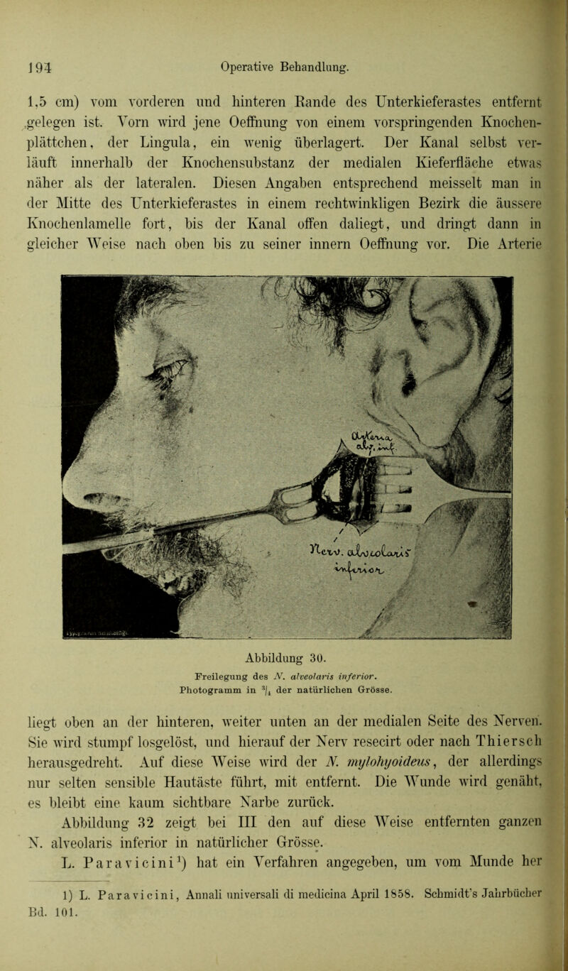 1,5 cm) vom vorderen und hinteren Bande des Unterkieferastes entfernt ,gelegen ist. Yorn wird jene Oeffnung yon einem vorspringenden Knochen- plâttchen, der Lingula, ein wenig überlagert. Der Kanal selbst ver- lânft innerhalb der Knochensubstanz der medialen Kieferflache etwas nàher als der latéral en. Diesen Angaben entsprechend meisselt man in der Mitte des Unterkieferastes in einem reehtwinkligen Bezirk die àussere Knochenlamelle fort, bis der Kanal offen daliegt, und dringt dann in gleicher Weise nach oben bis zu seiner innern Oeffnung vor. Die Arterie Abbildung 30. Freilegung des N. alveolaris inferior. Photogramm in 3/4 der natiirliclien Grosse. liegt oben an der hinteren, weiter unten an der medialen Seite des Nerven. Sie wird stumpf losgelôst, und hierauf der Nerv resecirt oder nach Thiersch herausgedreht. Auf diese Weise wird der N. mylohyoideus, der allerdings nur selten sensible Hautàste führt, mit entfernt. Die Wunde wird genâht, es bleibt eine kaum sichtbare Narbe zurück. Abbildung 32 zeigt bei III den auf diese Weise entfernten ganzen N. alveolaris inferior in natürlicher Grrôsse. L. Paravicini1) hat ein Verfahren angegeben, um vom Munde her 1) L. Paravicini, Annali universali di raedicina April 1858. Schmidt’s Janrbücber Bd. 101.