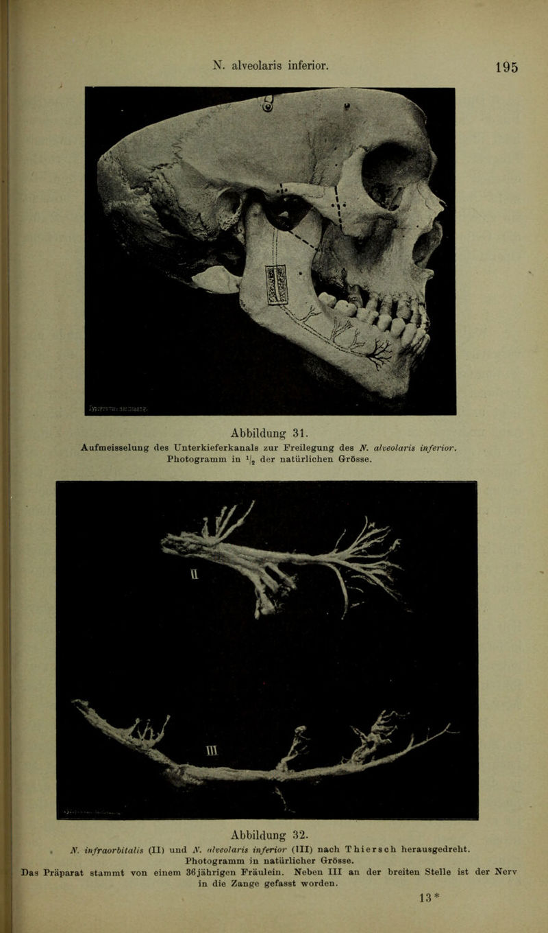 Abbildung 31. Aufmeisselung des Unterkieferkanals zur Freilegung des N. alveolaris inferior. Photogramm in x/2 der natürlichen G-rôsse. Abbildung 32. N. infraorbitalis (II) und N. alveolaris inferior (III) nach T hiers ch herausgedreht. Photogramm in natürlicher Grôsse. Das Pràparat stammt von einem 36jahrigen Fraulein. Neben III an der breiten Stelle ist der Nerv in die Zange gefasst worden. 13