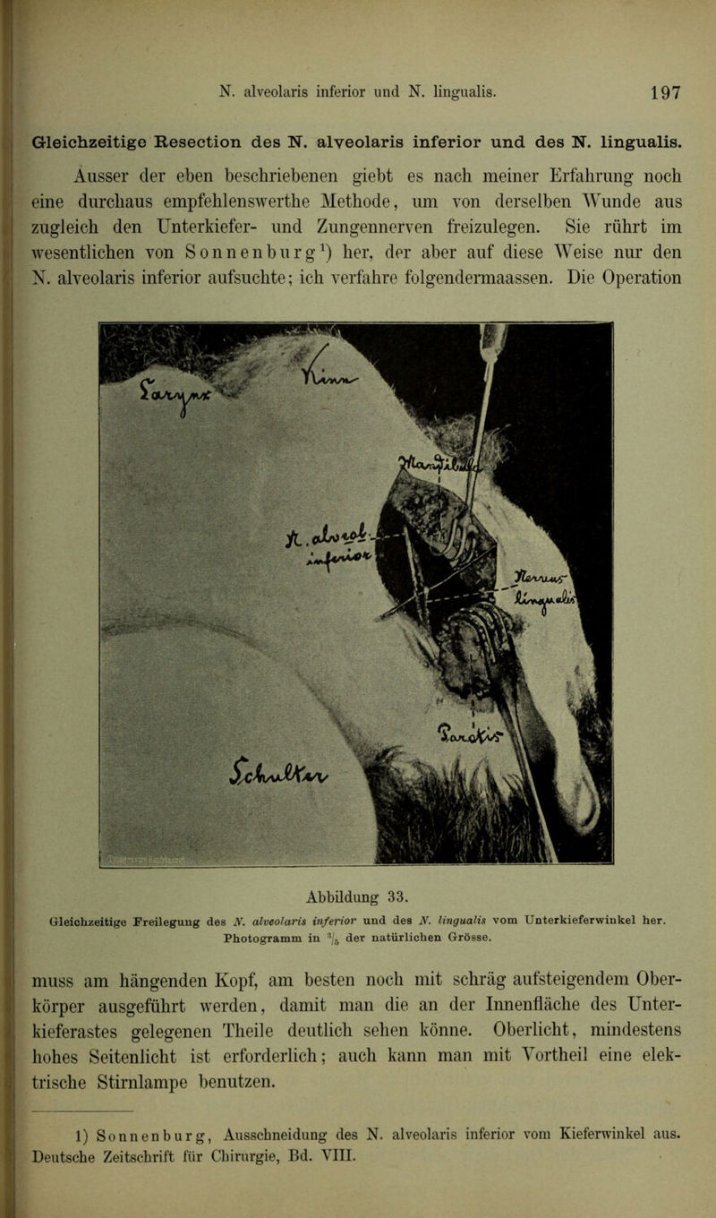 Gleichzeitige Resection des N. alveolaris inferior und des N. lingualis. Ausser der eben beschriebenen giebt es nach meiner Erfahrung noch eine durcbaus empfehlenswerthe Méthode, um von derselben Wunde ans zugleich den Unterkiefer- und Zungennerven freizulegen. Sie rührt im wesentlichen von Sonnenburg1) her, der aber auf diese Weise nur den N. alveolaris inferior aufsuchte ; ich verfahre folgendermaassen. Die Operation Abbildung 33. Gleichzeitige Freileguug des N. alveolaris inferior und des N. lingualis vom Unterkieferwinkel her. Photogramm in s/5 der natürlichen Grosse. muss am hângenden Kopf, am besten noch mit schrâg aufsteigendem Ober- kôrper ausgeführt werden, damit man die an der Innenflàche des Unter- kieferastes gelegenen Theile deutlich sehen kônne. Oberlicht, mindestens hohes Seitenlicht ist erforderlich ; auch kann man mit Yortheil eine elek- trische Stirnlampe benutzen. 1) Sonnenburg, Ausschneidung des N. alveolaris inferior vom Kieferwinkel aus. Deutsche Zeitschrift für Chirurgie, Bd. VIII.
