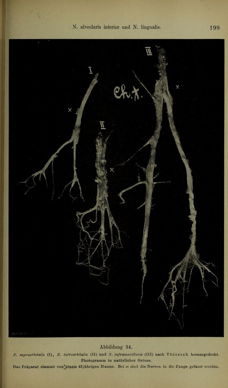 Abbildung 34. y. supraorbitalis (I), N. infraorbitalis (II) und A. inframaxillai'is (III) nach Thiersch herausgedrelit. Pliotogramm in natürlicher Grosse.