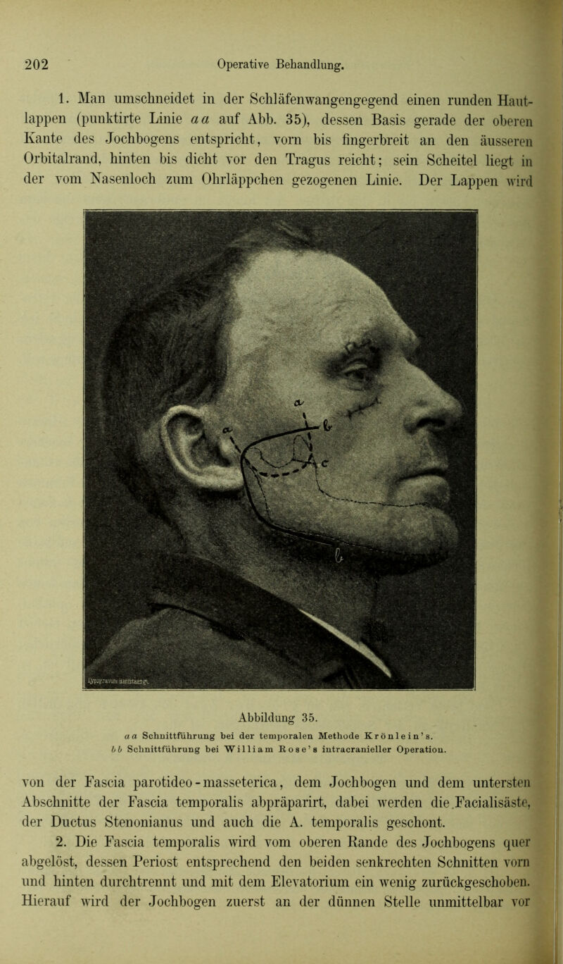 1. Man umschneidet in der Schlâfenwangengegend einen runden Haut- lappen (punktirte Linie a a auf Abb. 35), dessen Basis gerade der oberen Ivante des Jochbogens entspricht, vorn bis fingerbreit an den àusseren Orbitalrand, hinten bis dicht vor den Tragus reicht; sein Scbeitel liegt in der vom Nasenloch zum Ohrlâppchen gezogenen Linie. Der Lappen wird Abbildung 35. a a Schnittführung bei der temporalen Méthode Krônlein’s. b b Schnittführung bei William Rose’s intracranieller Operation. von der Fascia parotideo - masseterica, dem Jochbogen und dem untersten Abschnitte der Fascia temporalis abpràparirt, dabei werden die Facialisâste, der Ductus Stenonianus und aucb die A. temporalis geschont. 2. Die Fascia temporalis wird vom oberen Bande des Jochbogens quel* abgelôst, dessen Periost entsprechend den beiden senkrechten Schnitten vom und hinten durchtrennt und mit dem Elevatorium ein wenig zurückgeschoben. Hierauf wird der Jochbogen zuerst an der dünnen Stelle unmittelbar vor