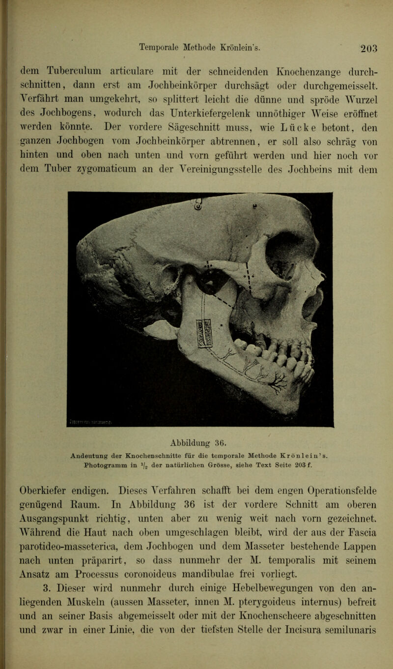 clem Tuberculum articulare mit der schneidenden Ivnochenzange durch- schnitten, dann erst am Jochbeinkôrper durchsâgt oder durchgemeisselt. Verfâhrt man umgekehrt, so splittert leicht die dünne und sprôde Wurzel des Jochbogens, wodurch das Unterkiefergelenk unnôthiger Weise eroffnet werden kônnte. Der vordere Sâgeschnitt muss, wie Lücke betont, den ganzen Jochbogen vom Jochbeinkôrper abtrennen, er soll also schrâg von hinten und oben nach unten und vorn geführt werden und hier noch vor dem Tuber zygomaticum an der Yereinigungsstelle des Jochbeins mit dem Abbildung 36. Andeutung der Knochenschnitte fiir die temporale Méthode Krônlein’s. Photogramm in x/2 der natiirlichen Grosse, siehe Text Seite 203 f. Oberkiefer endigen. Dieses Yerfahren schafft bei dem engen Operationsfelde genügend Raum. In Abbildung 36 ist der vordere Sohnitt am oberen Ausgangspunkt richtig, unten aber zu wenig weit nach vorn gezeichnet. Wàhrend die Haut nach oben umgeschlagen bleibt, wird der aus der Fascia parotideo-masseterica, dem Jochbogen und dem Masseter bestehende Lappen nach unten pràparirt, so dass nunmehr der M. temporalis mit seinem Ansatz am Processus coronoideus mandibulae frei vorliegt. 3. Dieser wird nunmehr durch einige Hebelbewegungen von den an- liegenden Muskeln (aussen Masseter, innen M. pterygoideus intemus) befreit und an seiner Basis abgemeisselt oder mit der Knochenscheere abgeschnitten und zwar in einer Linie, die von der tiefsten Stelle der Incisura semilunaris