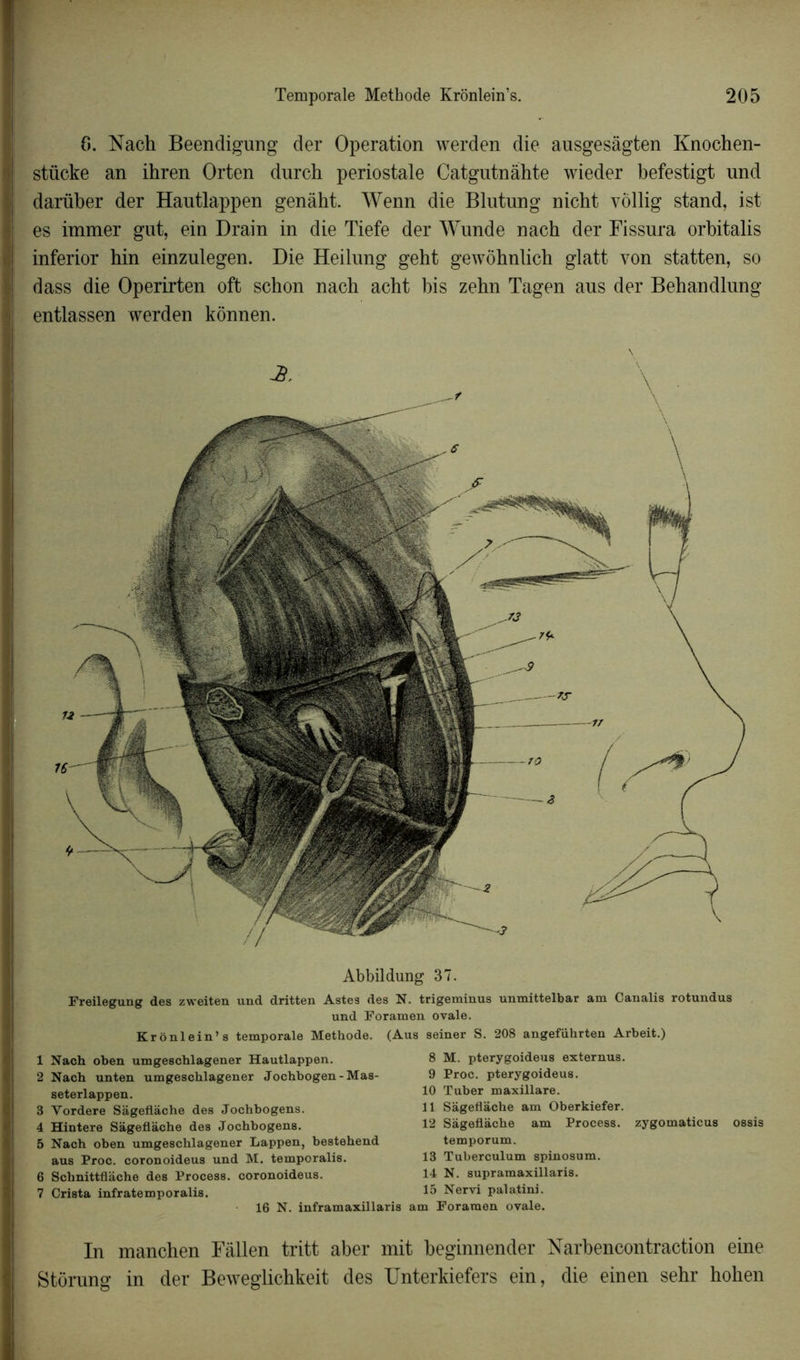 6. Nach Beendigung der Operation werden die ausgesâgten Knochen- stücke an ihren Orten durch periostale Catgutnàhte wieder befestigt und darüber der Hautlappen genàht. Wenn die Blutung nicht yollig stand, ist es immer gut, ein Drain in die Tiefe der Wunde nach der Fissura orbitalis inferior hin einzulegen. Die Heilung geht gewôhnlich glatt von statten, so dass die Operirten oft schon nach acht bis zehn Tagen aus der Bebandlung entlassen werden kônnen. Abbildung 37. Freilegung des zweiten und dritten Astes des N. trigeminus unmittelbar am Canalis rotundus und Foramen ovale. Krônlein’s temporale Méthode. (Aus seiner S. 208 angeführten Arbeit.) 1 Nach oben umgeschlagener Hautlappen. 2 Nach unten umgeschlagener Jochbogen-Mas- seterlappen. 3 Vordere Sageflache des Jochbogens. 4 Hintere Sageflache des Jochbogens. 5 Nach oben umgeschlagener Lappen, bestehend aus Proc, coronoideus und M. temporalis. 6 Schnittflâche des Process. coronoideus. 7 Cri8ta infratemporalis. 16 N. inframaxilla 8 M. pterygoideus externus. 9 Proc, pterygoideus. 10 Tuber maxillare. 11 Sageflache am Oberkiefer. 12 Sageflache am Process. zygomaticus ossis temporum. 13 Tuberculum spinosum. 14 N. supramaxillaris. 15 Nervi palatini. am Foramen ovale. In manchen Fâllen tritt aber mit beginnender Narbencontraction eine Stdrung in der Beweglichkeit des Unterkiefers ein, die einen sehr hohen