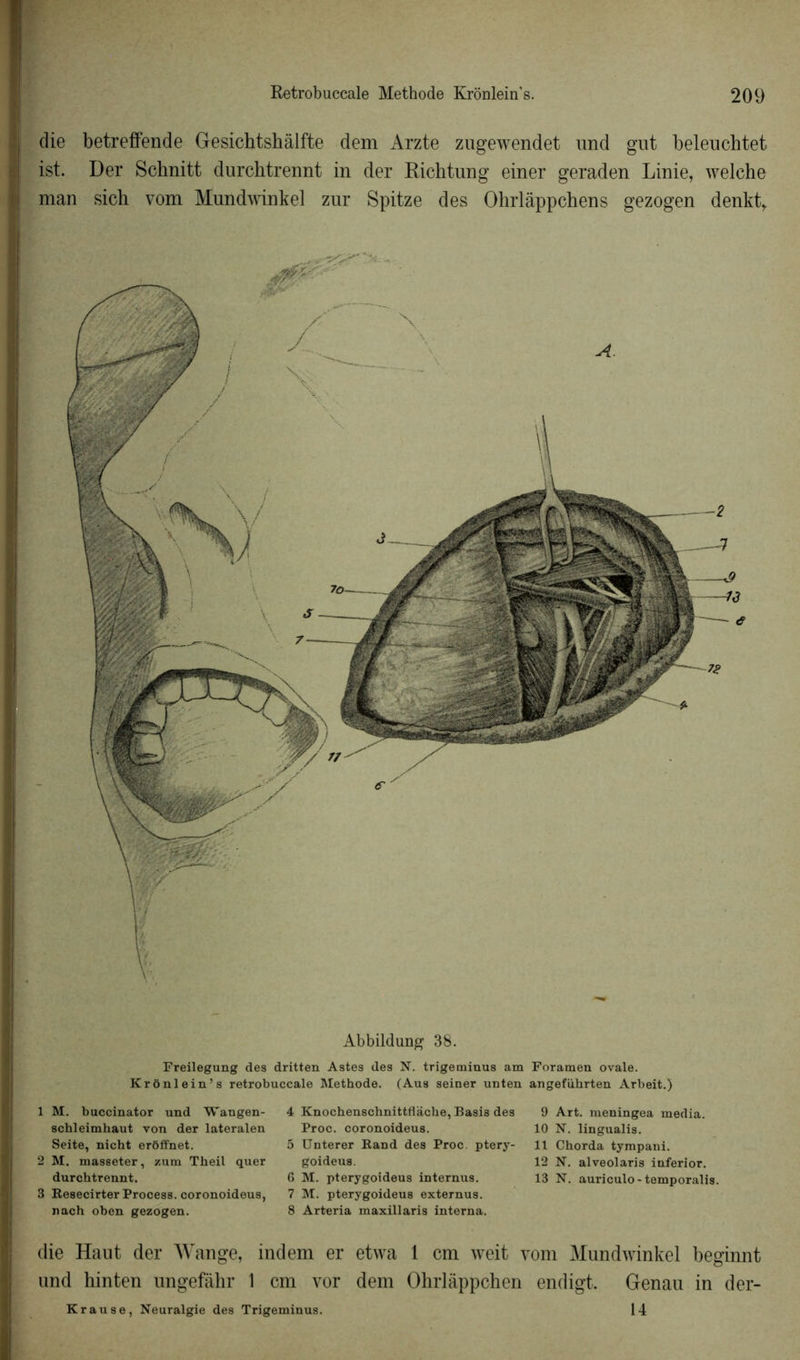 die betreffende Gesichtshàlfte dem Arzte zugewendet und gut beleuchtet ist. Der Schnitt durchtrennt in der Richtung einer geraden Linie, welche man sich vom Mundwinkel znr Spitze des Ohrlàppchens gezogen denktr Abbildung 38. Freilegung des dritten Astes des N. trigeminus am Foramen ovale. Krônlein’s retrobuccale Méthode. (Aus seiner unten angeführten Arbeit.) 1 M. buccinator und Wangen- schleimhaut von der lateralen Seite, nicht erôffnet. 2 M. masseter, zum Theil quer durchtrennt. 3 ResecirterProcess. coronoideus, nach oben gezogen. 4 Knochenschnittflàche, Basis des Proc, coronoideus. 5 Unterer Rand des Proc, ptery- goideus. 6 M. pterygoideus internus. 7 M. pterygoideus externus. 8 Arteria maxillaris interna. 9 Art. meningea media. 10 N. lingualis. 11 Chorda tympani. 12 N. alveolaris inferior. 13 N. auriculo-temporalis. die Haut der Wange, indem er etwa 1 cm weit vom Mundwinkel beginnt und hinten ungefàhr 1 cm vor dem Ohrlâppchen endigt. Genau in der- Krause, Neuralgie des Trigeminus. 14