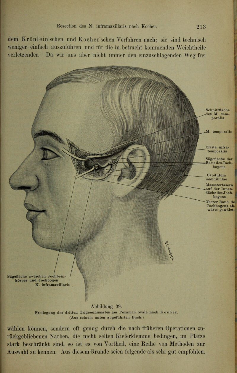 déni Krônlein’schen und Kocher’schen Yerfahren nach; sie sind technisch weniger einfach auszuführen und für die in betracht komraenden Weichtheile verletzender. Da wir uns aber nicht immer den einzuschlagenden Weg frei Sâgeflàche zwischen kôrper und Jochbogen N. inframaxillaris temporalis Schnittflàche M. tem- poralis infra- temporalis Sàgeflache der Basisdes Joch- bogens Capitulum maudibulae Masseterfasern H der Innen- I flàchedes Jocb- ||lj bogens Kaud del Jochbogens ab-H warts gewalzt. Abbildung 39. Preilegung des dritten Trigeminusastes am Foramen ovale nach Kocher. (Aus scinem unten angefiihrten Buch.) wâhlen kônnen, sondern oft genug durch die nach früheren Operationen zu- rückgebliebenen Narben, die nicht selten Kieferklemme bedingen, im Platze stark beschrânkt sind, so ist es von Vortheil, eine Keihe von Methoden zur Auswahl zu kennen. Aus diesem Grunde seien folgende als sehr gut empfohien.