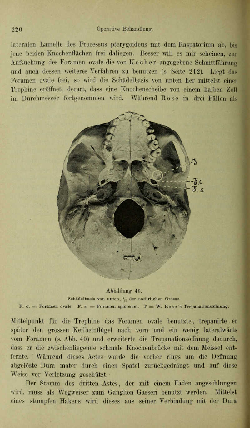 lateralen Lamelle des Processus pterygoideus mit dem Raspatorium ab, bis jene beiden Knochenflâchen frei daliegen. Besser will es mil* scheinen, zur Aufsucbung des Foramen ovale die von K o c h e r angegebene Schnittführung und auch dessen weiteres Yerfahren zu benutzen (s. Seite 212). Liegt das Foramen ovale frei, so wird die Schâdelbasis von unten lier mittelst einer Trephine erôffnet, derart, dass eine Knochenscheibe von einem halben Zoll im Durchmesser fortgenommen Avird. Wàhrend Rose in drei Fàllen als Abbildung 40. Schadelbasis von unten, ]/2 der natürlicben Grosse. F. o. = Foramen ovale. F. s. = Foramen spinosum. T = W. R ose’s Trepanationsôffnung. Mittelpunkt für die Trephine das Foramen ovale benutzte, trepanirte er spâter den grossen Keilbeinflügel nach vorn und ein wenig lateralwârts vom Foramen (s. Abb. 40) und erweiterte die Trepanationsôffnung dadurch, dass er die zwischenliegende schmale Knochenbrücke mit dem Meissel ent- femte. Wàhrend dieses Actes wurde die vorher rings um die Oeffnung abgelôste Dura mater durch einen Spatel zurückgedrângt und auf diese Weise vor Yerletzung geschützt. • Der Stamm des dritten Astes, der mit einem Faden angeschlungen wird, muss als Wegweiser zum Ganglion Gasseri benutzt werden. Mittelst eines stumpfen Hakens wird dieses aus seiner Yerbindung mit der Dura