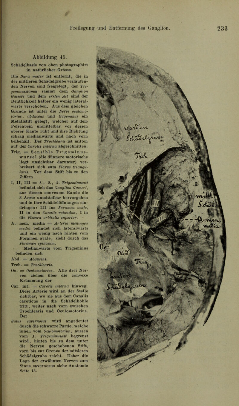 Abbildung 45. Schàdelbasis von oben photographirt in natürlicber Grôsse. Die Dura mater ist entfernt, die in der mittleren Schâdelgrube verlaufen- den Nerven sind freigelegt, der Tri- geminusstamm sammt dem Ganglion Gasseri und dem ersten Ast sind der Deutlichkeit halber ein wenig lateral- wàrts verschoben. Aus dem gleicben Grunde ist unter die Nervi oculoino- torius, abducens und trigeminus ein Metallstift gelegt, welcher auf dem Felsenbein unmittelbar vor dessen obérer Xante ruht und ihre Eichtung schrâg medianwàrts und nacb vorn beibebâlt. Der Trochlearis ist mitten auf der Carotis interna abgescbnitten. Trig. = Sensible Trigeminus- wurzel (die dünnere motorische liegt unsichtbar darunter) ver- breitert sicb zum Plexus triangu- laris. Yor dem Stift bis zu den Ziffern I, II, III — 1., 2., 3. Trigeminusast befindet sich das Ganglion Gasseri, aus dessen convexem Eau de die 3 Aeste unmittelbar hervorgehen und in ihre Schadelôffnungen ein- dringen: III ins Foramen ovale, II in den Canalis rotundus, I in die Fissura orbitalis superior. A. men. media = Arteria meningea media befindet sich lateralwârts und ein wenig nach binten vom Foramen ovale, zieht durch das Foramen spinosum. Medianwàrts vom Trigeminus befinden sich Abd. = Abducens. Trcb. = Trochlearis. Oc. = Oculomotorivs. Aile drei Ner- ven zieben über die convexe Krümmung der Car. int. = Carotis interna hinweg. Diese Arterie wird an der Stelle sicbtbar, wo sie aus dem Canalis caroticus in die Schàdelhohle tritt, weiter nacb vorn zwischen Trochlearis und Oculomotorius. Der Sinus cavernosus wird angedeutet durch die schwarze Partie, welche innen vom Oculomotorius, aussen vom 1. Trigeminusast begrenzt wird, hinten bis zu dem unter die Nerven geschobenen Stift, vorn bis zur Grenze der mittleren Schâdelgrube reicht. Ueber die Lage der erwàbnten Nerven zum Sinus cavernosus siebe Anatomie Seite 13.
