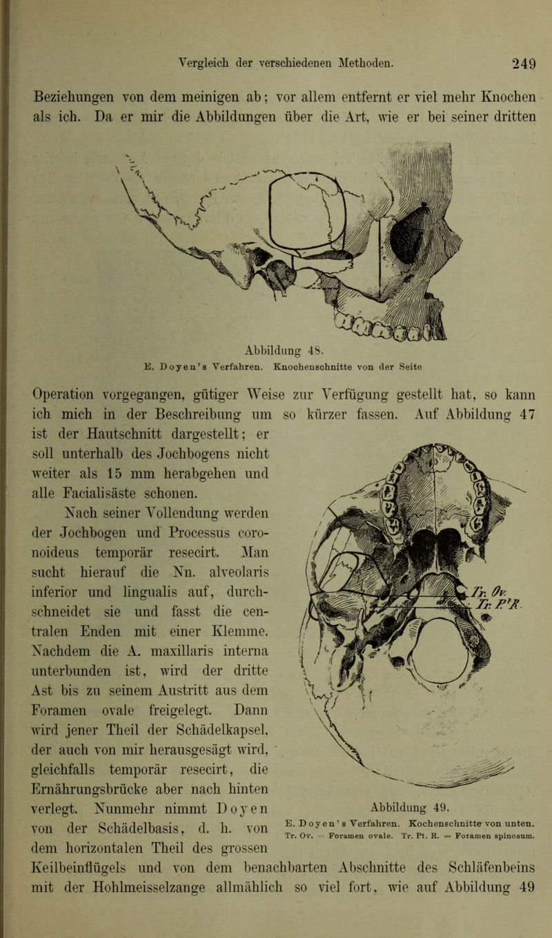 Beziehungen von dem meinigen ab ; vor allem entfernt er viel mehr Knochen als ich. Da er mir die Abbildungen über die Art, \vie er bei seiner dritten Operation vorgegangen, gütiger Weise zur Yerfügung gestellt hat, so kann ich mich in der Beschreibung um ist der Hautschnitt dargestellt; er soit unterhalb des Jochbogens nicht weiter als 15 mm herabgehen und aile Facialisàste schonen. Nach seiner Vollendung werden der Jochbogen und' Processus coro- noideus temporar resecirt. Man sucht hierauf die Nn. alveolaris inferior und lingualis auf, durch- schneidet sie und fasst die cen- tralen Enden mit einer Klemme. Nachdem die A. maxillaris interna unterbunden ist, wird der dritte Ast bis zu seinem Austritt aus dem Foramen ovale freigelegt. Dann wird jener Theil der Schâdelkapsel, der auch von mir herausgesâgt wird, gleichfalls temporar resecirt, die Ernàhrungsbrücke aber nach hinten so kiirzer fassen. Auf Abbildung 47 verlegt. Nunmehr nimmt Doyen Abbildung 49. von der Schadelbasis, d. h. von E. Doyen-S Verfahren Kochensehnittevonunten. Tr. Ov. Foramen ovale. Tr. Pt. R. = Foramen spinosum. dem horizontalen Theil des grossen Keilbeinflügels und von dem benachbarten Abschnitte des Schlâfenbeins mit der Hohlmeisselzange allmàhlich so viel fort, wie auf Abbildung 49
