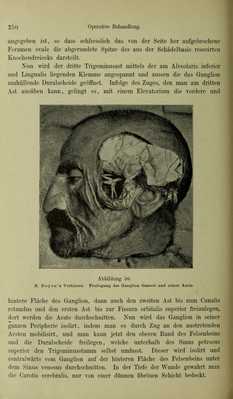 angegeben ist, so dass schliesslich das von der Seite her aufgebrochene Foramen ovale die abgerundete Spitze des ans der Schâdelbasis resecirten Ivnochendreiecks darstellt. Nun wird der dritte Trigeminnsast mittels der am Alveolaris inferior und Lingualis liegenden Klemme angespannt und aussen die das Ganglion umhüllende Duralscbeide geôfîhet. Infolge des Znges, den man am dritten Ast ansüben kann, gelingt es, mit einem Elevatorium die vordere und Abbildung 50. E. Doyen’s Verfahren. Freilegung des Ganglion Gasseri und seiner Aeste. kintere Flâche des Ganglion, dann auch den zweiten Ast bis znm Canalis rotundus und den ersten Ast bis zur Fissura orbitalis superior freizulegen, dort werden die Aeste durchschnitten. Nun wird das Ganglion in seiner ganzen Peripherie isolirt, indem man es durch Zug an den austretenden Aesten mobilisirt, und man kann jetzt den oberen Rand des Felsenbeins und die Duralscheide freilegen, welche unterhalb des Sinus petrosus superior den Trigeminusstamm selbst umfasst. Dieser wird isolirt und centralwârts vom Ganglion auf der hinteren Flâche des Felsenbeins unter dem Sinus venosus durchschnitten. In der Tiefe der Wunde gewahrt man die Carotis cerebralis, nur von einer dünnen fibrôsen Schicht bedeckt.