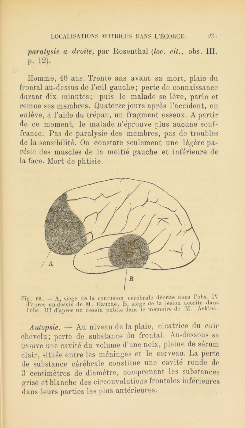 paralysie a clroite, par Rosenthal (loc. cil., obs. Ill, p. 12). Homme, 46 ans. Trente ans avant sa mort, plaie du frontal au-dessus de l’ceil gauche; perte de connaissance durant dix minutes; puis le malade se leve, parle et remue ses membres. Quatorze jours apres l’accident, on enleve, a l’aide du trepan, un fragment osseux. A partir de ce moment, le malade n’eprouve plus aucune souf- france. Pas de paralysie des membres, pas de troubles de la sensibilite. On constate seulement une legere pa- resie des muscles de la moitie gauche et inferieure de la face. Mort de phtisie. j B / Fig. 60. — A, siege de la contusion cerebrale decrite dans l’obs. \\ d’apres undessin de M. Gauche. B, siege de la lesion decrite dans Fobs. Ill d’apres un dessin publie dans le memoire de M. Askins. Aulopsie. — Au niveau de la plaie, cicatrice du cuir chevelu; perte de substance du trontal. Au-dessous se trouve une cavite du volume d’une noix, pleine de serum clair, situee entre les meninges et le cerveau. La perte de substance cerebrale constitue une cavite ronde de 3 centimetres de diametre, comprenant les substances grise et blanche des circonvolutions frontales inferieures dans leurs parties les plus anterieures.