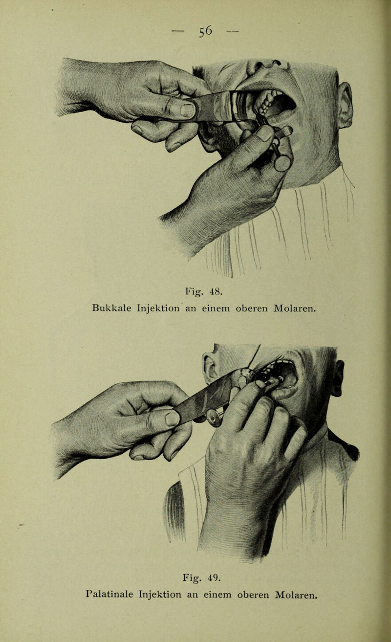 Fig. 48. Bukkale Injektion an einem oberen Molaren. Fig. 49. Palatinale Injektion an einem oberen Molaren.