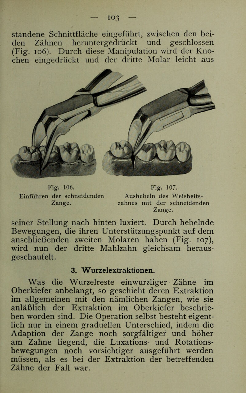 standene Schnittfläche eingeführt, zwischen den bei- den Zähnen heruntergedrückt und geschlossen (Fig. 106). Durch diese Manipulation wird der Kno- chen eingedrückt und der dritte Molar leicht aus Fig. 106. Fig. 107. Einführen der schneidenden Aushebeln des Weisheits- Zange. zahnes mit der schneidenden Zange. seiner Stellung nach hinten luxiert. Durch hebelnde Bewegungen, die ihren Unterstützungspunkt auf dem anschließenden zweiten Molaren haben (Fig. 107), wird nun der dritte Mahlzahn gleichsam heraus- geschaufelt. 3. Wurzelextraktionen. Was die Wurzelreste ein wurzliger Zähne im Oberkiefer anbelangt, so geschieht deren Extraktion Im allgemeinen mit den nämlichen Zangen, wie sie anläßlich der Extraktion im Oberkiefer beschrie- ben worden sind. Die Operation selbst besteht eigent- lich nur in einem graduellen Unterschied, indem die Adaption der Zange noch sorgfältiger und höher am Zahne liegend, die Luxations- und Rotations- bewegungen noch vorsichtiger ausgeführt werden müssen, als es bei der Extraktion der betreffenden Zähne der Fall war.