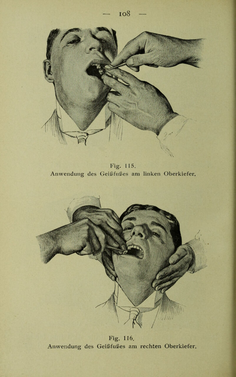 Fig- H5. Anwendung des Geißfußes am linken Oberkiefer. Fig. 116. Anwendung des Geißfußes am rechten Oberkiefer.