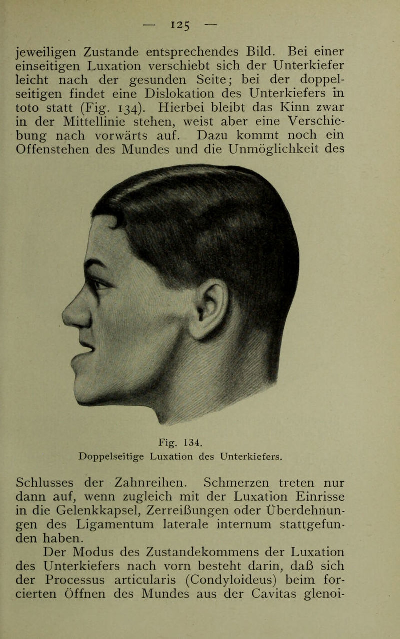 jeweiligen Zustande entsprechendes Bild. Bei einer einseitigen Luxation verschiebt sich der Unterkiefer leicht nach der gesunden Seite; bei der doppel- seitigen findet eine Dislokation des Unterkiefers in toto statt (Fig. 134). Hierbei bleibt das Kinn zwar in der Mittellinie stehen, weist aber eine Verschie- bung nach vorwärts auf. Dazu kommt noch ein Offenstehen des Mundes und die Unmöglichkeit des Fig. 134. Doppelseitige Luxation des Unterkiefers. Schlusses der Zahnreihen. Schmerzen treten nur dann auf, wenn zugleich mit der Luxation Einrisse in die Gelenkkapsel, Zerreißungen oder Überdehnun- gen des Ligamentum laterale internum stattgefun- den haben. Der Modus des Zustandekommens der Luxation des Unterkiefers nach vorn besteht darin, daß sich der Processus articularis (Condyloideus) beim for- cierten Öffnen des Mundes aus der Cavitas glenoi-