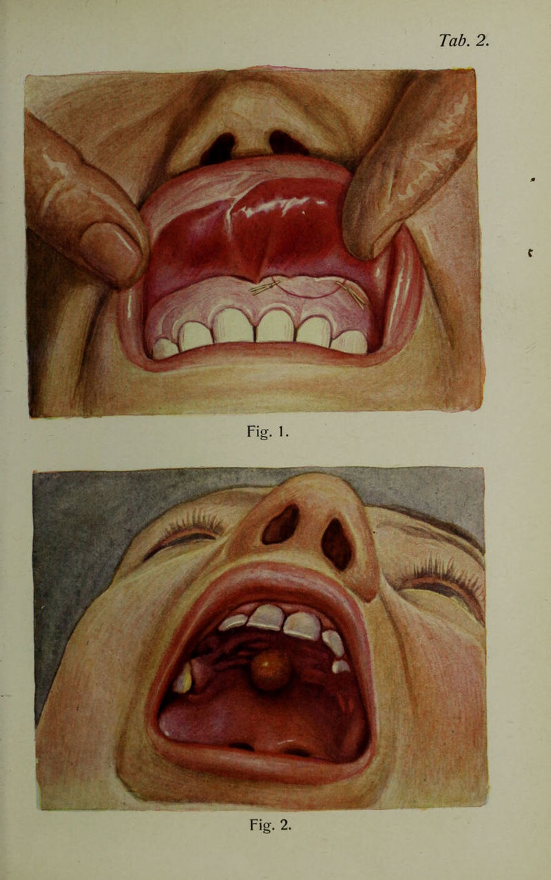 Tab. 2. Fig. 1. Fig. 2.