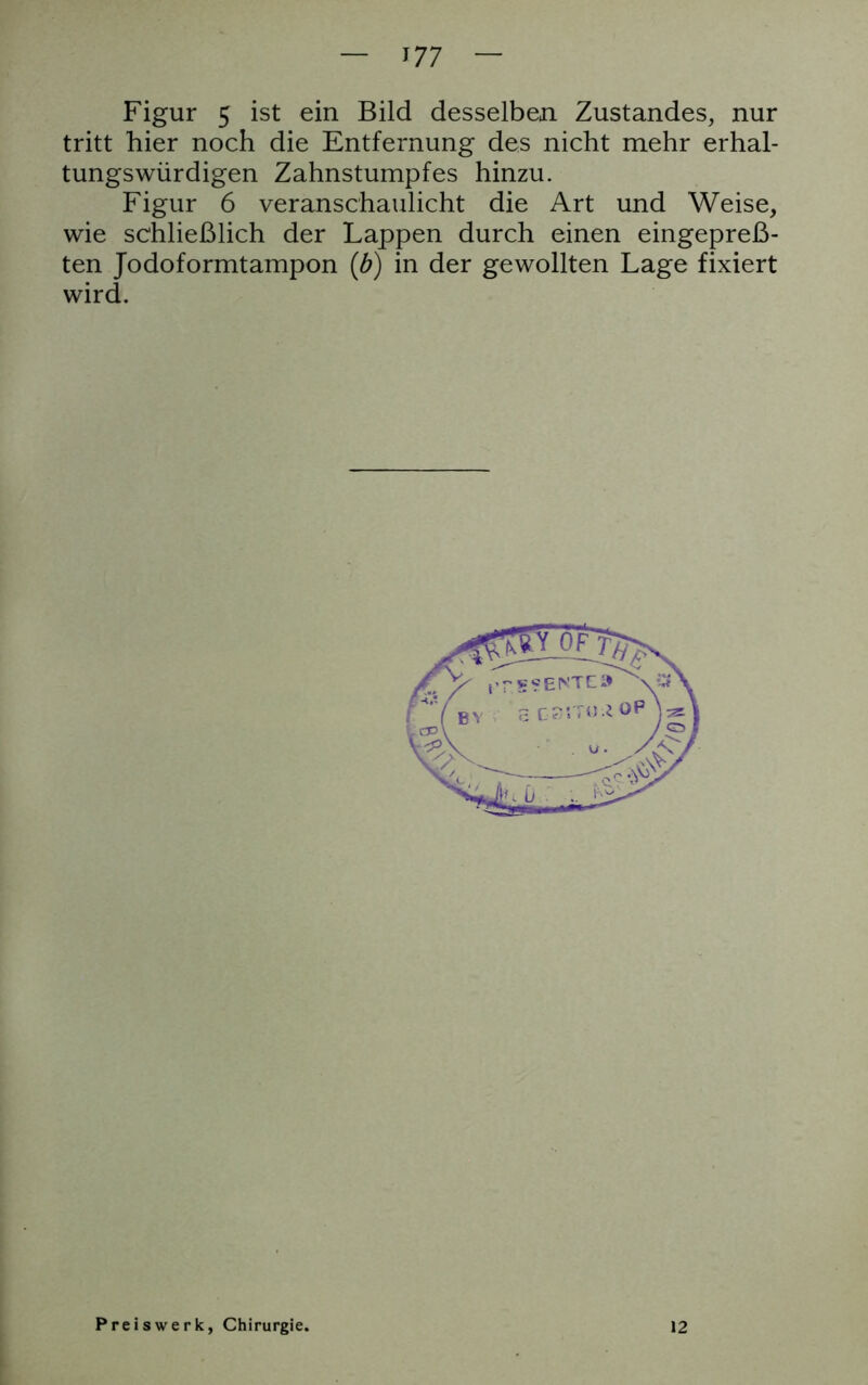 177 Figur 5 ist ein Bild desselben Zustandes, nur tritt hier noch die Entfernung des nicht mehr erhal- tungswürdigen Zahnstumpfes hinzu. Figur 6 veranschaulicht die Art und Weise, wie schließlich der Lappen durch einen eingepreß- ten Jodoformtampon {b) in der gewollten Lage fixiert wird.