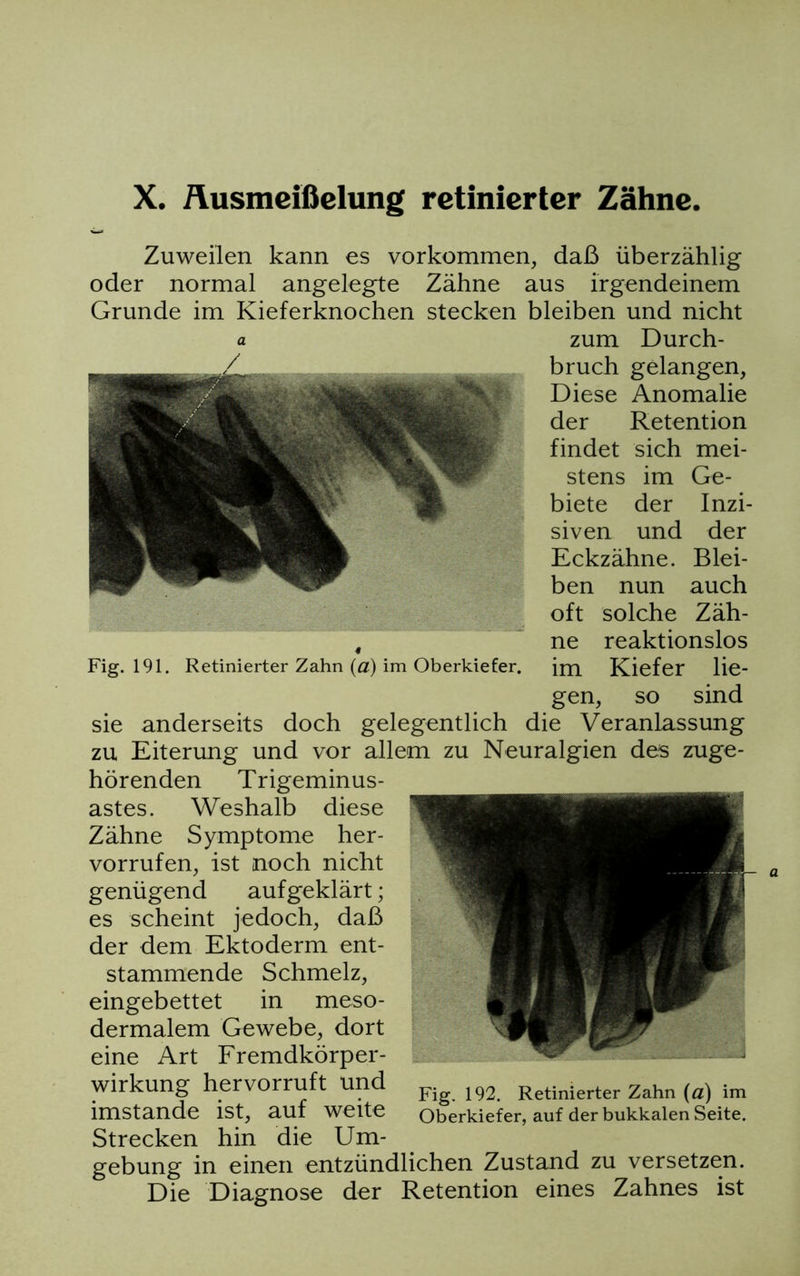 X. Äusmeißelung rctinicrter Zähne. Zuweilen kann es Vorkommen, daß überzählig oder normal angelegte Zähne aus irgendeinem Grunde im Kieferknochen stecken bleiben und nicht a zum Durch- bruch gelangen, Diese Anomalie der Retention findet sich mei- stens im Ge- biete der Inzi- siven und der Eckzähne. Blei- ben nun auch oft solche Zäh- 4 ne reaktionslos Fig. 191. Retinierter Zahn (a) im Oberkiefer. im Kiefer lie- gen, so sind sie anderseits doch gelegentlich die Veranlassung zu Eiterung und vor allem zu Neuralgien des zuge- hörenden Trigeminus- astes. Weshalb diese Zähne Symptome her- vorrufen, ist noch nicht genügend aufgeklärt; es scheint jedoch, daß der dem Ektoderm ent- stammende Schmelz, eingebettet in meso- dermalem Gewebe, dort eine Art Fremdkörper- wirkung hervorruft und imstande ist, auf weite Strecken hin die Um- Fig. 192. Retinierter Zahn (ä) im Oberkiefer, auf der bukkalen Seite. gebung in einen entzündlichen Zustand zu versetzen. Die Diagnose der Retention eines Zahnes ist