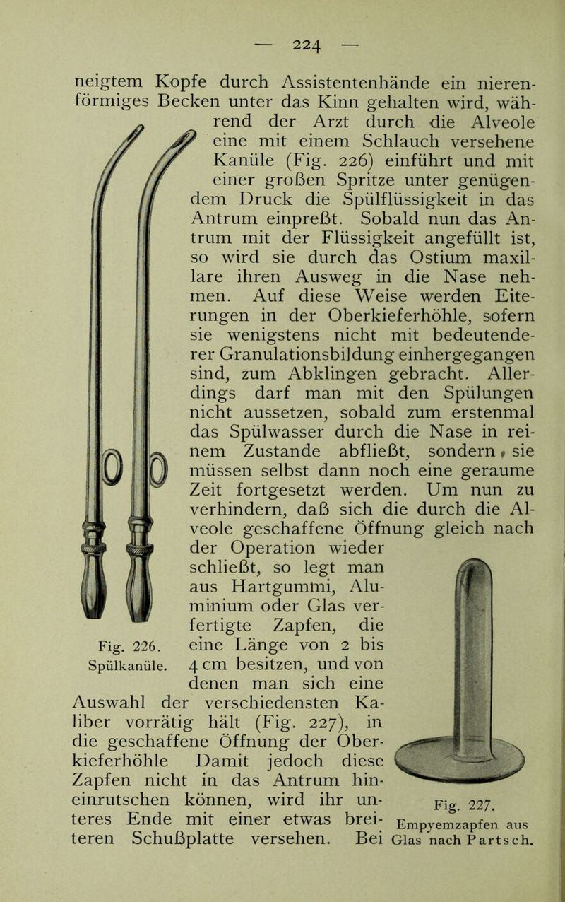 neigtem Kopfe durch Assistentenhände ein nieren- förmiges Becken unter das Kinn gehalten wird, wäh- rend der Arzt durch die Alveole eine mit einem Schlauch versehene Kanüle (Fig. 226) einführt und mit einer großen Spritze unter genügen- dem Druck die Spülflüssigkeit in das Antrum einpreßt. Sobald nun das An- trum mit der Flüssigkeit angefüllt ist, so wird sie durch das Ostium maxil- lare ihren Ausweg in die Nase neh- men. Auf diese Weise werden Eite- rungen in der Oberkieferhöhle, sofern sie wenigstens nicht mit bedeutende- rer Granulationsbildung einhergegangen sind, zum Abklingen gebracht. Aller- dings darf man mit den Spülungen nicht aussetzen, sobald zum erstenmal das Spülwasser durch die Nase in rei- 01 ^ nem Zustande abfließt, sondern t sie j fl müssen selbst dann noch eine geraume Zeit fortgesetzt werden. Um nun zu verhindern, daß sich die durch die Al- veole geschaffene Öffnung gleich nach der Operation wieder schließt, so legt man aus Hartgummi, Alu- minium oder Glas ver- fertigte Zapfen, die eine Länge von 2 bis 4 cm besitzen, und von denen man sich eine Auswahl der verschiedensten Ka- liber vorrätig hält (Fig. 227), in die geschaffene Öffnung der Ober- kieferhöhle Damit jedoch diese Zapfen nicht in das Antrum hin- einrutschen können, wird ihr un- teres Ende mit einer etwas brei- Fig. 226. Spülkanüle. Fig. 227. Empyemzapfen aus teren Schußplatte versehen. Bei Glas nach Partsch.