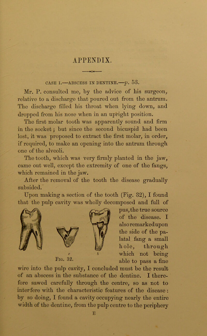 APPENDIX. ■ CASE I. ABSCESS IN DENTINE.—£>. 53. Mr. P. consulted rue, by tbe advice of bis surgeon, relative to a discharge that poured out from tbe antrum. Tbe discharge filled bis throat when lying down, and dropped from bis nose when in an upright position. Tbe first molar tooth was apparently sound and firm in the socket; but since tbe second bicuspid bad been lost, it was proposed to extract tbe first molar, in order, if required, to make an opening into tbe antrum through one of tbe alveoli. Tbe tooth, which was very firmly planted in tbe jaw, came out well, except tbe extremity of one of tbe fangs, which remained in the jaw. After tbe removal of tbe tooth tbe disease gradually subsided. Upon making a section of tbe tooth (Fig. 32), I found that tbe pulp cavity was wholly decomposed and full of f pus, tbe true source of tbe disease. I also remarked upon tbe side of tbe pa- latal fang a small bole, through which not being- able to pass a fine wire into tbe pulp cavity, I concluded must be tbe result of an abscess in tbe substance of tbe dentine. I there- fore sawed carefully through tbe centre, so as not to interfere with tbe characteristic features of the disease: by so doing, I found a cavity occupying nearly tbe entire width of the dentine, from tbe pulp centre to tbe periphery E C Fig. 32.