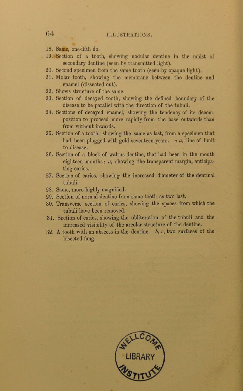 G4 18. Same, one-fifth do. 19. -Section of a tooth, showing nodular dentine in the midst of secondary dentine (seen by transmitted light). 20. Second specimen from the same tooth (seen by opaque light). 21. Molar tooth, showing the membrane between the dentine and enamel (dissected out). 22. Shows structure of the same. 23. Section of decayed tooth, showing the defined boundary of the disease to be parallel with the direction of the tubuli. 21. Sections of decayed enamel, showing the tendency of its decom- position to proceed more rapidly from the base outwards than from without inwards. 25. Section of a tooth, showing the same as last, from a specimen that had been plugged with gold seventeen years, a a, line of limit to disease. 26. Section of a block of walrus dentine, that had been in the mouth eighteen months: a, showing the transparent margin, anticipa- ting caries. 27. Section of caries, showing the increased diameter of the dentinal tubuli. 28. Same, more highly magnified. 29. Section of normal dentine from same tooth as two last. 30. Transverse section of caries, showing the spaces from which the tubuli have been removed. 31. Section of caries, showing the obliteration of the tubuli and the increased visibility of the areolar structure of the dentine. 32. A tooth with an abscess in the dentine, b, c, two surfaces of the bisected fang.