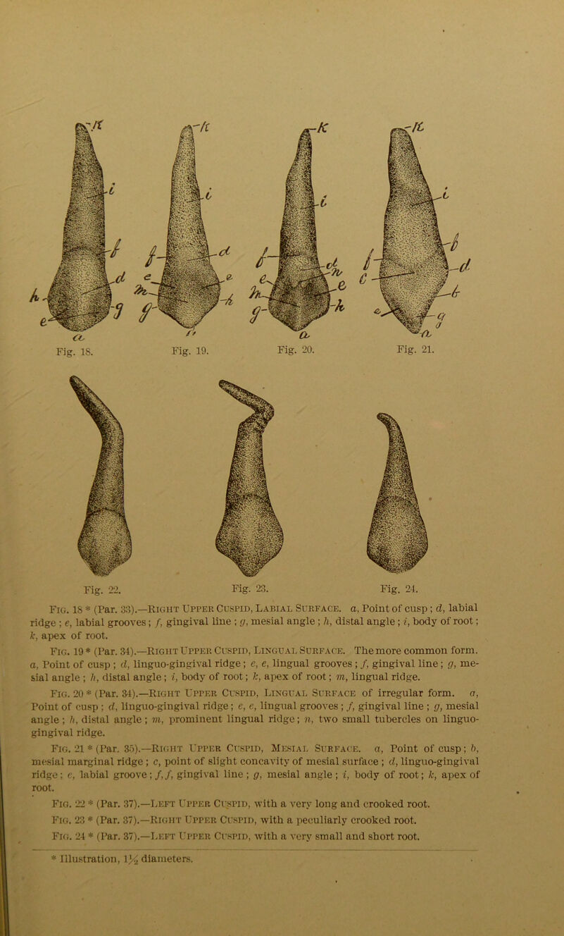 Fig. 22. Fig. 23. Fig. 24. Fig. IS * (Par. 33).—Right Upper Cuspid, Labial Surface, a, Point of cusp; d, labial ridge ; e, labial grooves; /, gingival line ; g, mesial angle ; h, distal angle; i, body of root; k, apex of root. Fig. 19 * (Par. 34).—Right Upper Cuspid, Lingual Surface. The more common form. a, Point of cusp ; d, linguo-gingival ridge; e, e, lingual grooves ; /, gingival line; g, me- sial angle ; li, distal angle ; i, body of root; apex of root; m, lingual ridge. Fig. 20 * (Par. 31).—Right Upper Cuspid, Lingual Surface of irregular form, a, Point of cusp ; d, linguo-gingival ridge; e, e, lingual grooves ; /, gingival line ; g, mesial angle; h, distal angle; m, prominent lingual ridge; ft, two small tubercles on linguo- gingival ridge. Fig. 21 * (Par. 35).—Right Upper Cuspid, Mesial Surface, a, Point of cusp; b, mesial marginal ridge ; c, point of slight concavity of mesial surface; d, linguo-gingival ridge; c, labial groove;/,/, gingival line ; g, mesial angle; i, body of root; k, apex of root. Fig. 22 * (Par. 37).—Left Upper Cuspid, with a very long and crooked root. Fig. 23 * (Par. 37).—Right Upper Cuspid, with a peculiarly crooked root. Fig. 24 * (Par. 37).—Left Upper Cuspid, with a very small and short root. Fig. 20. Fig. 21. Cc Fig. IS. Fig. 19.