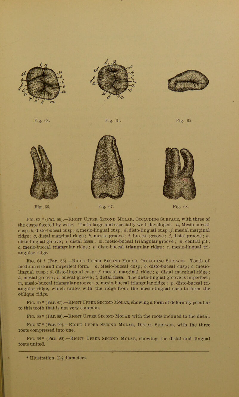 Fig.. 66. Fig. 67. Fig. 68. Fig. 63 * (Par. 86).—Right Upper Second Molar, Occluding Surface, with three of the cusps faceted by wear. Tooth large and especially well developed, a, Mesio-buccal cusp; b, disto-buccal cusp; c, mesio-lingual cusp; d, disto-lingual cusp;/, mesial marginal ridge ; g, distal marginal ridge; h, mesial groove; i, buccal groove ; j, distal groove ; k, disto-lingual groove; l, distal fossa ; in, mesio-buccal triangular groove ; n, central pit; o, mesio-buccal triangular ridge; p, disto-buccal triangular ridge ; r, mesio-lingual tri- angular ridge. Fig. 64 * (Par. 86).—Right Upper Second Molar, Occluding Surface. Tooth of medium size and imperfect form, a, Mesio-buccal cusp; b, disto-buccal cusp; c, mesio- lingual cusp; d, disto-lingual cusp ; /, mesial marginal ridge; g, distal marginal ridge ; h, mesial groove; i, buccal groove ; l, distal fossa. The disto-lingual groove is imperfect; m, mesio-buccal triangular groove; o, mesio-buccal triangular ridge ; p, disto-buccal tri- angular ridge, which unites with the ridge from the mesio-lingual cusp to form the oblique ridge. Fig. 65 * (Par. 87).—Right Upper Second Molar, showing a form of deformity peculiar to this tooth that is not very common. Fig. 66 * (Par. 89).—Right Upper Second Molar with the roots inclined to the distal. Fig. 67 * (Par. 90).—Right Upper Second Molar, Distal Surface, with the three roots compressed into one. Fig. 68 * (Par. 90).—Right Upper Second Molar, showing the distal and lingual roots united.