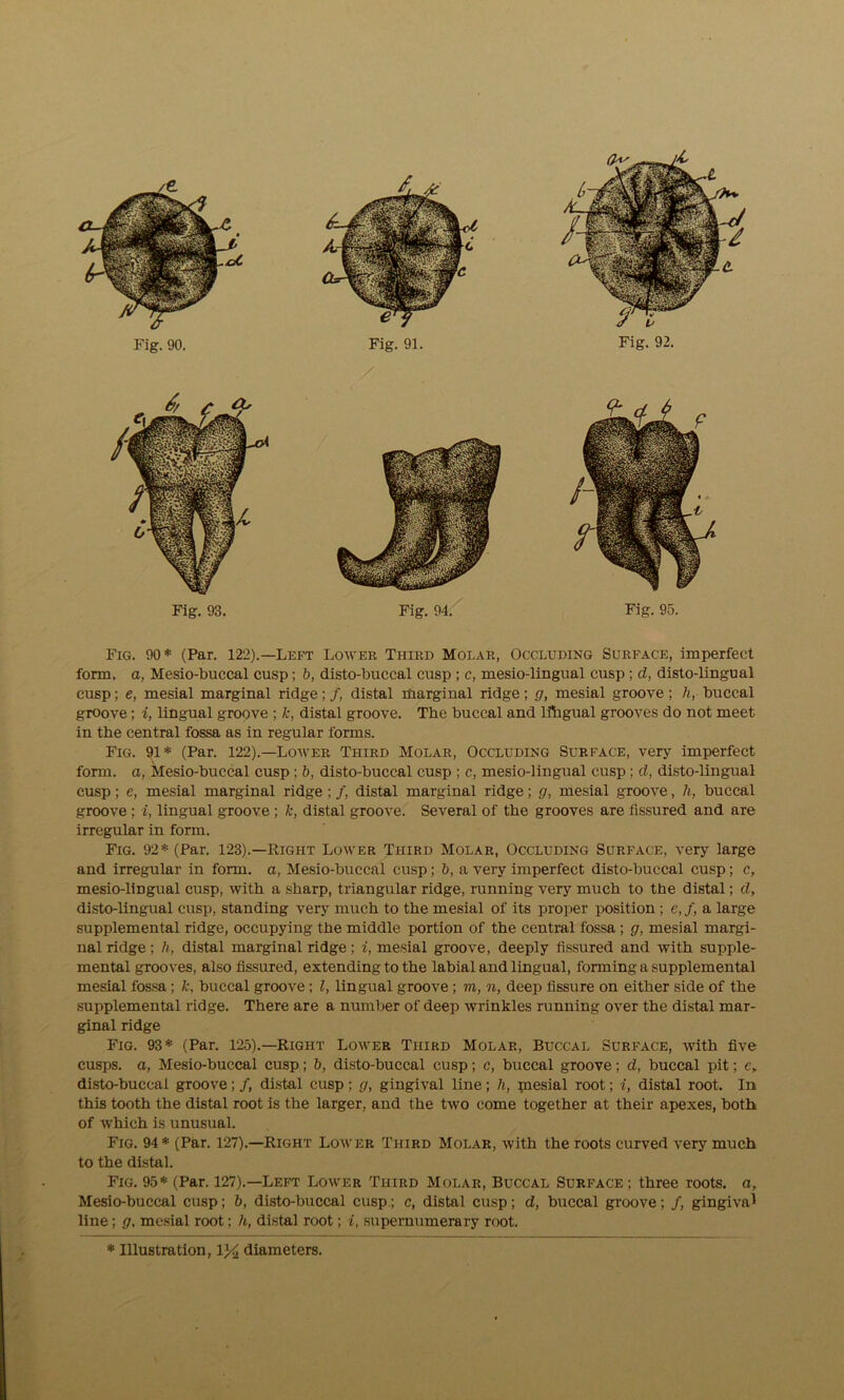 Fig. 90* (Par. 122).—Left Lower Third Molar, Occluding Surface, imperfect form, a, Mesio-buccal cusp; b, disto-buccal cusp ; c, mesio-lingual cusp ; d, disto-lingual cusp; e, mesial marginal ridge; /, distal marginal ridge; g, mesial groove; li, buccal groove; i, lingual groove ; k, distal groove. The buccal and lfhgual grooves do not meet in the central fossa as in regular forms. Fig. 91* (Par. 122).—Lower Third Molar, Occluding Surface, very imperfect form, a, Mesio-buccal cusp : b, disto-buccal cusp ; c, mesio-lingual cusp; d, disto-lingual cusp; e, mesial marginal ridge; /, distal marginal ridge; g, mesial groove, h, buccal groove ; i, lingual groove; k, distal groove. Several of the grooves are fissured and are irregular in form. Fig. 92* (Par. 123).—Right Lower Third Molar, Occluding Surface, very large and irregular in form, a, Mesio-buccal cusp; b, a very imperfect disto-buccal cusp; c, mesio-lingual cusp, with a sharp, triangular ridge, running very much to the distal; d, disto-lingual cusp, standing very much to the mesial of its proper position ; e,f, a large supplemental ridge, occupying the middle portion of the central fossa ; g, mesial margi- nal ridge; h, distal marginal ridge; i, mesial groove, deeply fissured and with supple- mental grooves, also fissured, extending to the labial and lingual, forming a supplemental mesial fossa; k, buccal groove; l, lingual groove; m, n, deep fissure on either side of the supplemental ridge. There are a number of deep wrinkles running over the distal mar- ginal ridge Fig. 93* (Par. 125).—Right Lower Third Molar, Buccal Surface, with five cusps, a, Mesio-buccal cusp; b, disto-buccal cusp; c, buccal groove; d, buccal pit; c, disto-buccal groove; /, distal cusp ; g, gingival line; h, piesial root; i, distal root. In this tooth the distal root is the larger, and the two come together at their apexes, both of which is unusual. Fig. 94* (Par. 127).—Right Lower Third Molar, with the roots curved very much to the distal. Fig. 95* (Par. 127).—Left Lower Third Molar, Buccal Surface; three roots, a, Mesio-buccal cusp; b, disto-buccal cusp; c, distal cusp; d, buccal groove; /, gingiva1 line; g, mesial root; h, distal root; i, supernumerary root.