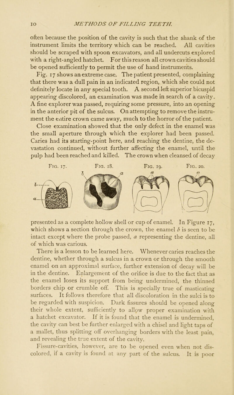 often because the position of the cavity is such that the shank of the instrument limits the territory which can be reached. All cavities should be scraped with spoon excavators, and all undercuts explored with a right-angled hatchet. For this reason all crown cavities should be opened sufficiently to permit the use of hand instruments. Fig. 17 shows an extreme case. The patient presented, complaining that there was a dull pain in an indicated region, which she could not definitely locate in any special tooth. A second left superior bicuspid appearing discolored, an examination was made in search of a cavity. A fine explorer was passed, requiring some pressure, into an opening in the anterior pit of the sulcus. On attempting to remove the instru- ment the entire crown came away, much to the horror of the patient. Close examination showed that the only defect in the enamel was the small aperture through which the explorer had been passed. Caries had its starting-point here, and reaching the dentine, the de- vastation continued, without further affecting the enamel, until the pulp had been reached and killed. The crown when cleansed of decay Fig. 17. Fig. 18. Fig. 19. Fig. 20. presented as a complete hollow shell or cup of enamel. In Figure 17, which shows a section through the crown, the enamel b is seen to be intact except where the probe passed, a representing the dentine, all of which was carious. There is a lesson to be learned here. Whenever caries reaches the dentine, whether through a sulcus in a crown or through the smooth enamel on an approximal surface, further extension of decay will be in the dentine. Enlargement of the orifice is due to the fact that as the enamel loses its support from being undermined, the thinned borders chip or crumble off. This is specially true of masticating surfaces. It follows therefore that all discoloration in the sulci is to be regarded with suspicion. Dark fissures should be opened along their whole extent, sufficiently to allow proper examination with a hatchet excavator. If it is found that the enamel is undermined, the cavity can best be further enlarged with a chisel and light taps of a mallet, thus splitting off overhanging borders with the least pain, and revealing the true extent of the cavity. Fissure-cavities, however, are to be opened even when not dis- colored, if a cavity is found at any part of the sulcus. It is poor