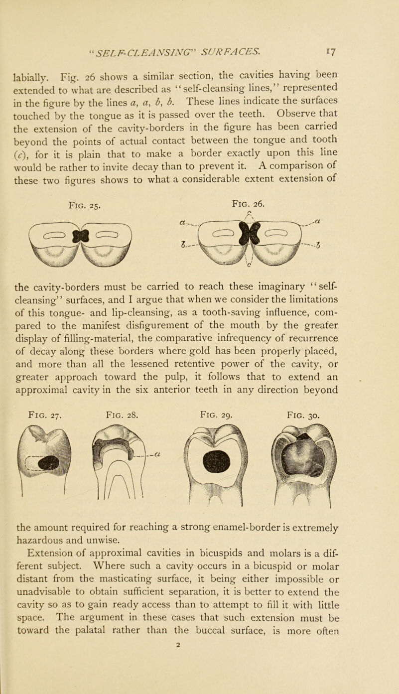 labially. Fig. 26 shows a similar section, the cavities having been extended to what are described as 41 self-cleansing lines, represented in the figure by the lines a, a, b, b. These lines indicate the surfaces touched by the tongue as it is passed over the teeth. Observe that the extension of the cavity-borders in the figure has been carried beyond the points of actual contact between the tongue and tooth (V), for it is plain that to make a border exactly upon this line would be rather to invite decay than to prevent it. A comparison of these two figures shows to what a considerable extent extension of Fig. 25. Fig. 26. c* r ' the cavity-borders must be carried to reach these imaginary “self- cleansing” surfaces, and I argue that when we consider the limitations of this tongue- and lip-cleansing, as a tooth-saving influence, com- pared to the manifest disfigurement of the mouth by the greater display of filling-material, the comparative infrequency of recurrence of decay along these borders where gold has been properly placed, and more than all the lessened retentive power of the cavity, or greater approach toward the pulp, it follows that to extend an approximal cavity in the six anterior teeth in any direction beyond Fig. 27. Fig. 28. Fig. 29. Fig. 30. the amount required for reaching a strong enamel-border is extremely hazardous and unwise. Extension of approximal cavities in bicuspids and molars is a dif- ferent subject. Where such a cavity occurs in a bicuspid or molar distant from the masticating surface, it being either impossible or unadvisable to obtain sufficient separation, it is better to extend the cavity so as to gain ready access than to attempt to fill it with little space. The argument in these cases that such extension must be toward the palatal rather than the buccal surface, is more often