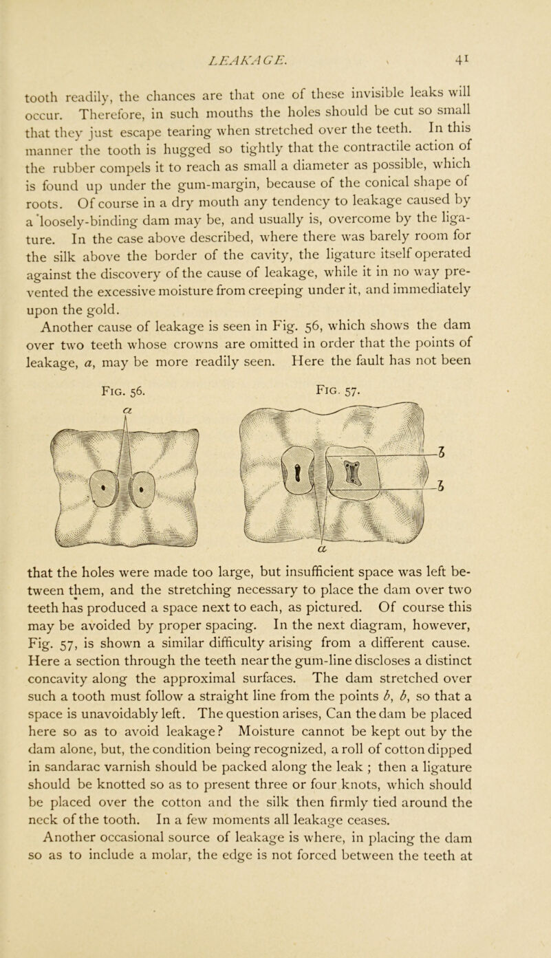 tooth readily, the chances are that one of these invisible leaks will occur. Therefore, in such mouths the holes should be cut so small that they just escape tearing- when stretched over the teeth. In this manner the tooth is hugged so tightly that the contractile action of the rubber compels it to reach as small a diameter as possible, which is found up under the gum-margin, because of the conical shape of roots. Of course in a dry mouth any tendency to leakage caused by a 'loosely-binding dam may be, and usually is, overcome by the liga- ture. In the case above described, where there was barely room for the silk above the border of the cavity, the ligature itself operated against the discovery of the cause of leakage, while it in no way pre- vented the excessive moisture from creeping under it, and immediately upon the gold. Another cause of leakage is seen in Fig. 56, which shows the dam over two teeth whose crowns are omitted in order that the points of leakage, a, may be more readily seen. Here the fault has not been Fig. 56. Fig. 57. that the holes were made too large, but insufficient space was left be- tween them, and the stretching necessary to place the dam over two teeth has produced a space next to each, as pictured. Of course this may be avoided by proper spacing. In the next diagram, however, Fig. 57, is shown a similar difficulty arising from a different cause. Here a section through the teeth near the gum-line discloses a distinct concavity along the approximal surfaces. The dam stretched over such a tooth must follow a straight line from the points b, b, so that a space is unavoidably left. The question arises, Can the dam be placed here so as to avoid leakage? Moisture cannot be kept out by the dam alone, but, the condition being recognized, a roll of cotton dipped in sandarac varnish should be packed along the leak ; then a ligature should be knotted so as to present three or four knots, which should be placed over the cotton and the silk then firmly tied around the neck of the tooth. In a few moments all leakage ceases. Another occasional source of leakage is where, in placing the dam so as to include a molar, the edge is not forced between the teeth at