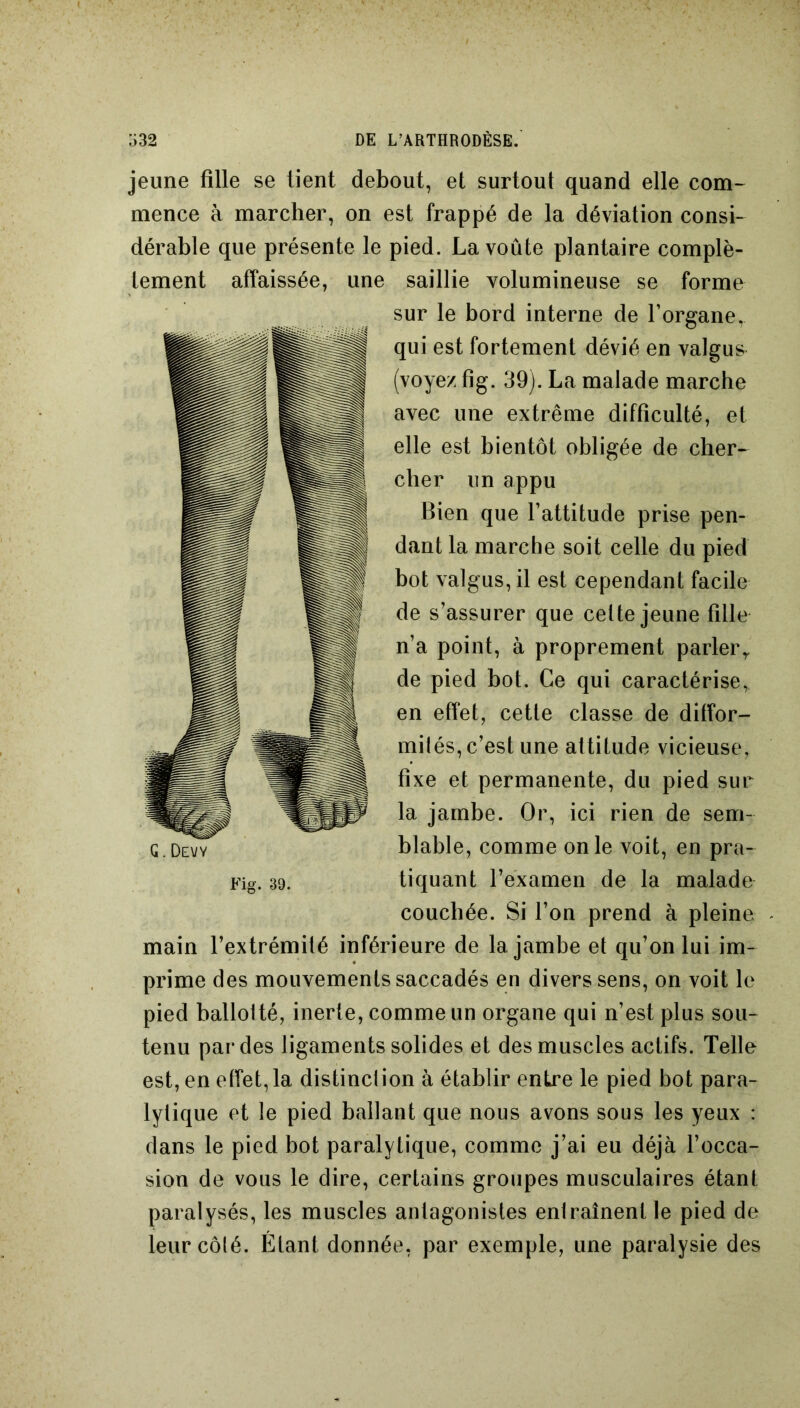 jeune fille se tient debout, et surtout quand elle com- mence à marcher, on est frappé de la déviation consi- dérable que présente le pied. La voûte plantaire complè- tement affaissée, une saillie volumineuse se forme sur le bord interne de l’organe, qui est fortement dévié en valgus^ (voyez fig. 39). La malade marche avec une extrême difficulté, et elle est bientôt obligée de cher- cher un appu Bien que l’attitude prise pen- dant la marche soit celle du pied bot valgus, il est cependant facile de s’assurer que celte jeune fille n’a point, à proprement parlerr de pied bot. Ce qui caractérise, en effet, cette classe de diffor- mités, c’est une altitude vicieuse, fixe et permanente, du pied sur la jambe. Or, ici rien de sem- blable, comme on le voit, en pra- tiquant l’examen de la malade couchée. Si l’on prend à pleine main l’extrémité inférieure de la jambe et qu’on lui im- prime des mouvements saccadés en divers sens, on voit le pied ballotté, inerte, comme un organe qui n’est plus sou- tenu par des ligaments solides et des muscles actifs. Telle est, en effet, la distinction à établir entre le pied bot para- lytique et le pied ballant que nous avons sous les yeux : dans le pied bot paralytique, comme j’ai eu déjà l’occa- sion de vous le dire, certains groupes musculaires étant paralysés, les muscles antagonistes entraînent le pied de leur côté. Étant donnée, par exemple, une paralysie des G. Devy