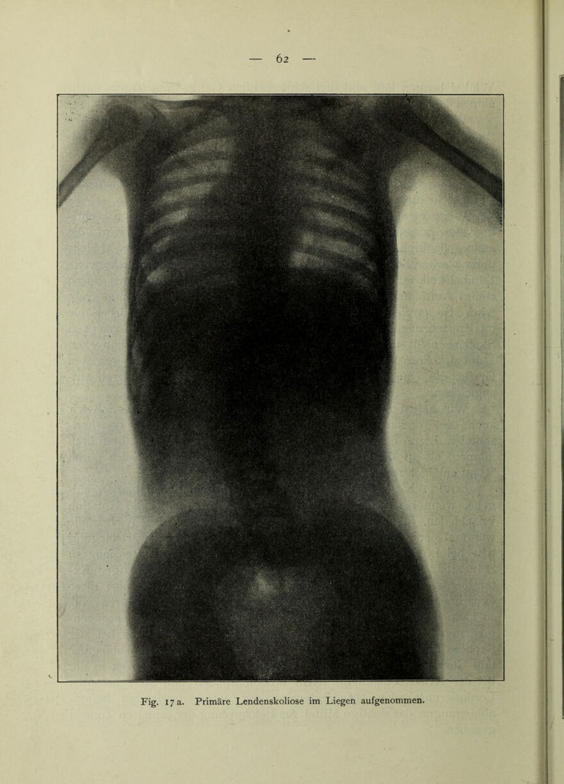 Fig. 17 a. Primäre Lendenskoliose im Liegen aufgenommen.