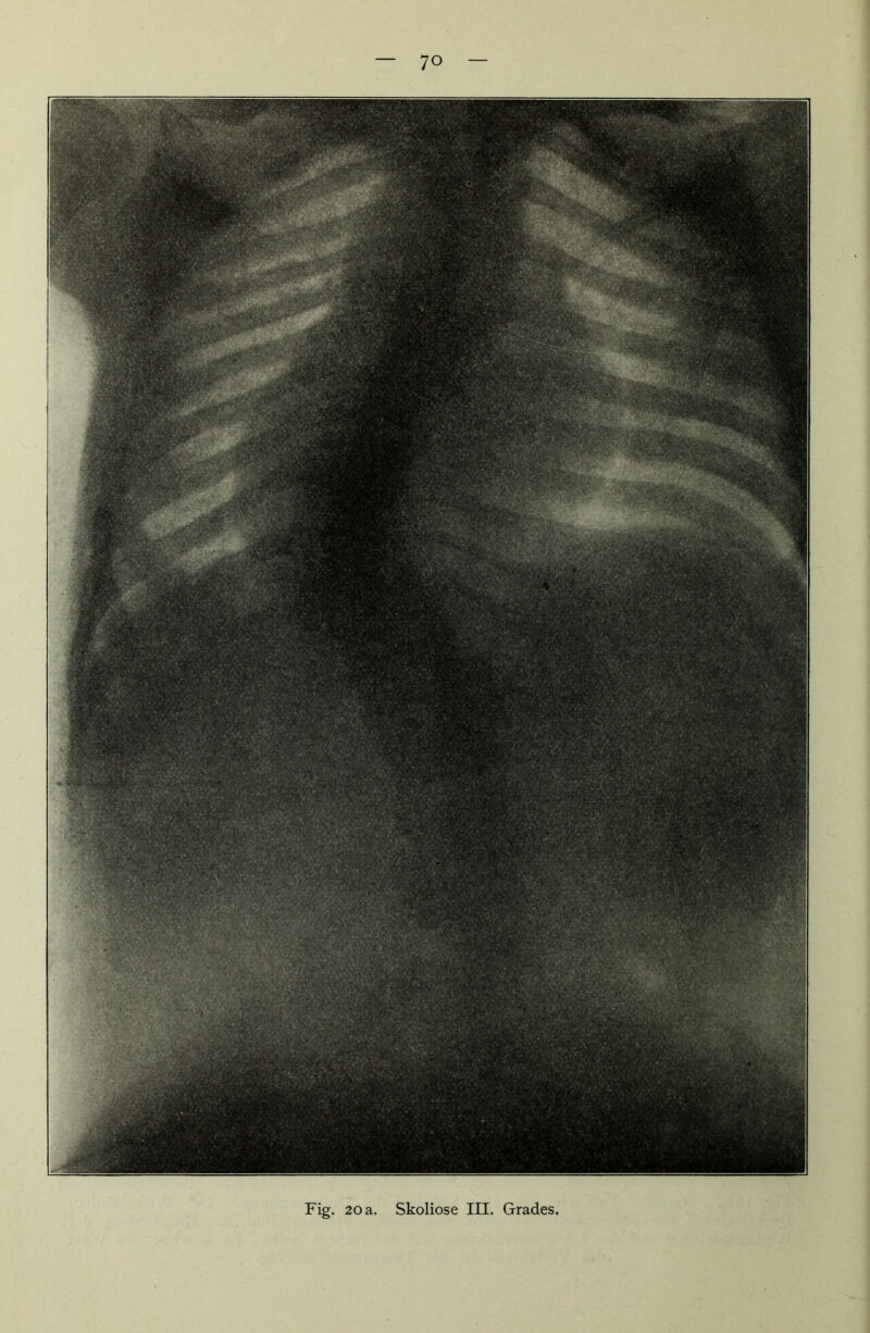 Fig. 20 a. Skoliose III. Grades.