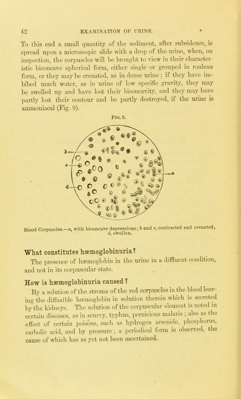 To tliis end a small quantity of the sediment, after subsidence, is spread upon a microscopic slide with a drop of the urine, when, on inspection, the corpuscles will be brought to view in their character- istic biconcave spherical form, either single or grouped in rouleau form, or they maybe crenated, as in dense urine ; if they have im- bibed much water, as in urine of low specific gravity, they may be swelled up and have lost their biconcavity, and they may have partly lost their contour and be partly destroyed, if the urine is ammoniacal (Fig. 9). Blood Corpuscles.—a, with biconcave depressions; 6 and c, contracted and crenatedj What constitutes haemogdobinuria? The presence of haemoglobin in the urine in a diffluent condition, and not in its corpuscular state. How is haemogdobinuria caused ? By a solution of the stroma of the red corpuscles in the blood leav- ing the diffusible haemoglobin in solution therein which is secreted by the kidneys. The solution of the corpuscular element is noted m certain diseases, as in scurvy, typhus, pernicious malaria ; also as the effect of certain poisons, such as hydrogen arsenide, phosphorus, carbolic acid, and by pressure; a periodical form is observed, the cause of which has as yet not been ascertained. Fig. 9. d, swollen.