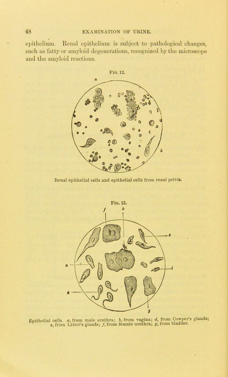 epithelium. Renal epithelium is subject to pathological changes, such as fatty or amyloid degenerations, recognized by the microscope and the amyloid reactions. Fig. 12. Renal epithelial cells and epithelial cells from renal pelvis. Epithelial cells a, from male urethra; b, from vagina; d, from Owner's glands; e, from Littre’s glands; /, from female urethra; g, from bladder. Fig. 13. / 6