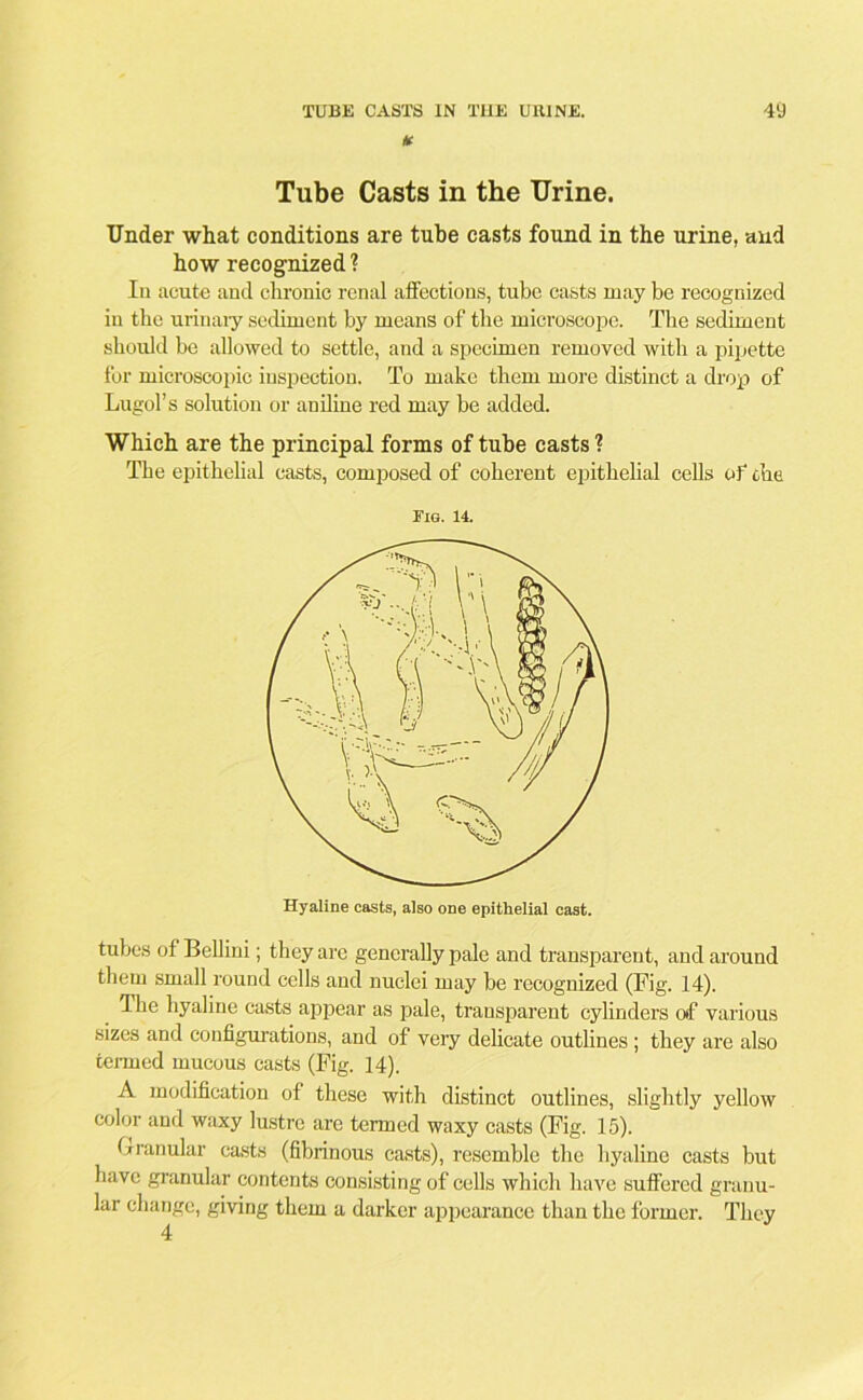 lK Tube Casts in the Urine. Under what conditions are tube casts found in the urine, and how recognized? In acute and chronic renal affections, tube casts may be recognized in the urinary sediment by means of the microscope. The sediment should be allowed to settle, and a specimen removed with a pipette for microscopic inspection. To make them more distinct a drop of Lugol’s solution or aniline red may he added. Which are the principal forms of tube casts ? The epithelial casts, composed of coherent epithelial cells of the Eig. 14. Hyaline easts, also one epithelial cast. tubes of Bellini; they arc generally pale and transparent, and around them small round cells and nuclei may he recognized (Fig. 14). The hyaline casts appear as pale, transparent cylinders of various sizes and configurations, and of very delicate outlines; they are also termed mucous casts (Fig. 14), A modification of these with distinct outlines, slightly yellow color and waxy lustre are termed waxy casts (Fig. 15). Granular casts (fibrinous casts), resemble the hyaline casts but have granular contents consisting of cells which have suffered granu- lar change, giving them a darker appearance than the former. They 4