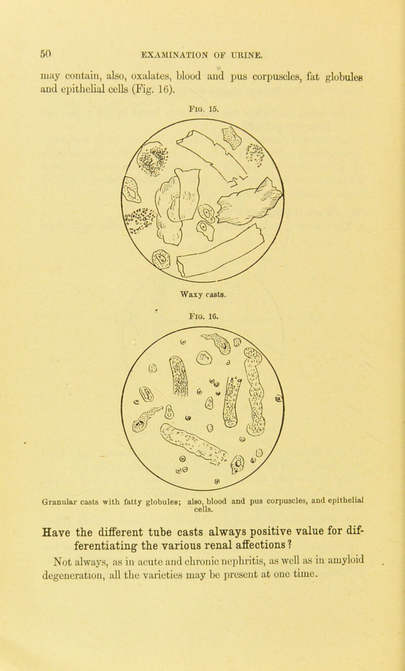 may contain, also, oxalates, blood and pus corpuscles, fat globules and epithelial cells (Fig. 16). Fig. 15. Waxy casts. Fig. 16. Granular casts with fatty globules; also, blood and pus corpuscles, and epithelial cells. Have the different tube casts always positive value for dif- ferentiating the various renal affections ? Not always, as in acute and chronic nephritis, as well as in amyloid degeneration, all the varieties may be present at one time.
