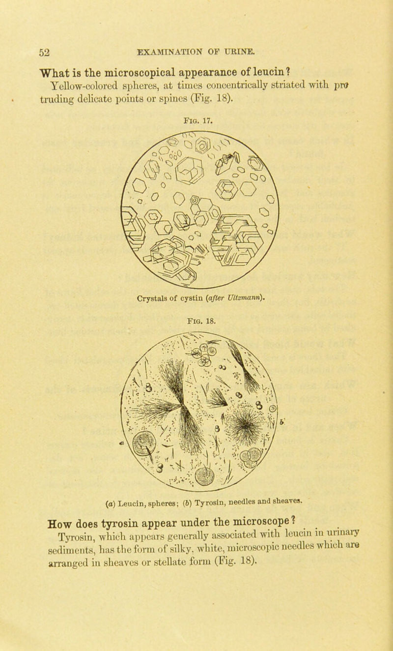 What is the microscopical appearance of lencin? Yellow-colored spheres, at times concentrically striated with pm trading delicate points or spines (Fig. 18). Fig. 17. Crystals of cystin (after Ultzmann). Fig. 18. (a) Leucin, spheres; (b) Tyrosin, needles and sheaves. How does tyrosin appear under the microscope ? Tyrosin, which appears generally associated with leucin in urinary sediments, has the form of silky, white, microscopic needles which are arranged in sheaves or stellate form (Fig. 18).