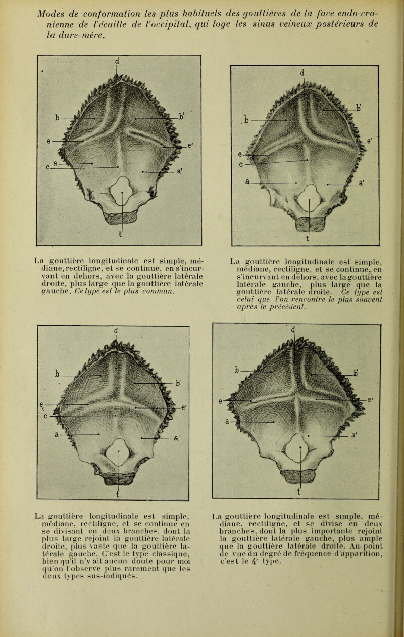 Modes de conformation les plus habituels des gouttières de la face endo-cra- nienne de récaille de l'occipital qui loge les sinus veineux postérieurs de la dure-mère. La gouttière longitudinale est simple, mé- diane, rectiligne, et se continue, en s’incur- vant en dehors, avec la gouttière latérale droite, plus large que la gouttière latérale gauche. Ce type est le plus commun. La gouttière longitudinale est simple, médiane, rectiligne, et se continue, en s’incurvant en dehors, avec la gouttière latérale gauche, plus large que la gouttière latérale droite. Ce type est celui que l’on rencontre le plus souvent après le précédent. La gouttière longitudinale est simple, médiane, rectiligne, et se continue en se divisant en deux branches, dont la plus large rejoint la gouttière latérale droite, plus \aste que la gouttière la- térale gauche. C'est le type classicpie, bien qu’il n’y ait aucun doute pour moi qu'on l’observe plus rarement ([ue les deux types sus-indi([ués. La gouttière longitudinale est simple, mé- diane, rectiligne, et se divise en deux branches, dont la plus importante rejoint la gouttière latérale gauche, plus ample que la gouttière latérale droite. Au> point de vue (lu degré de frécpience d’apparition, c’est le 4® type.