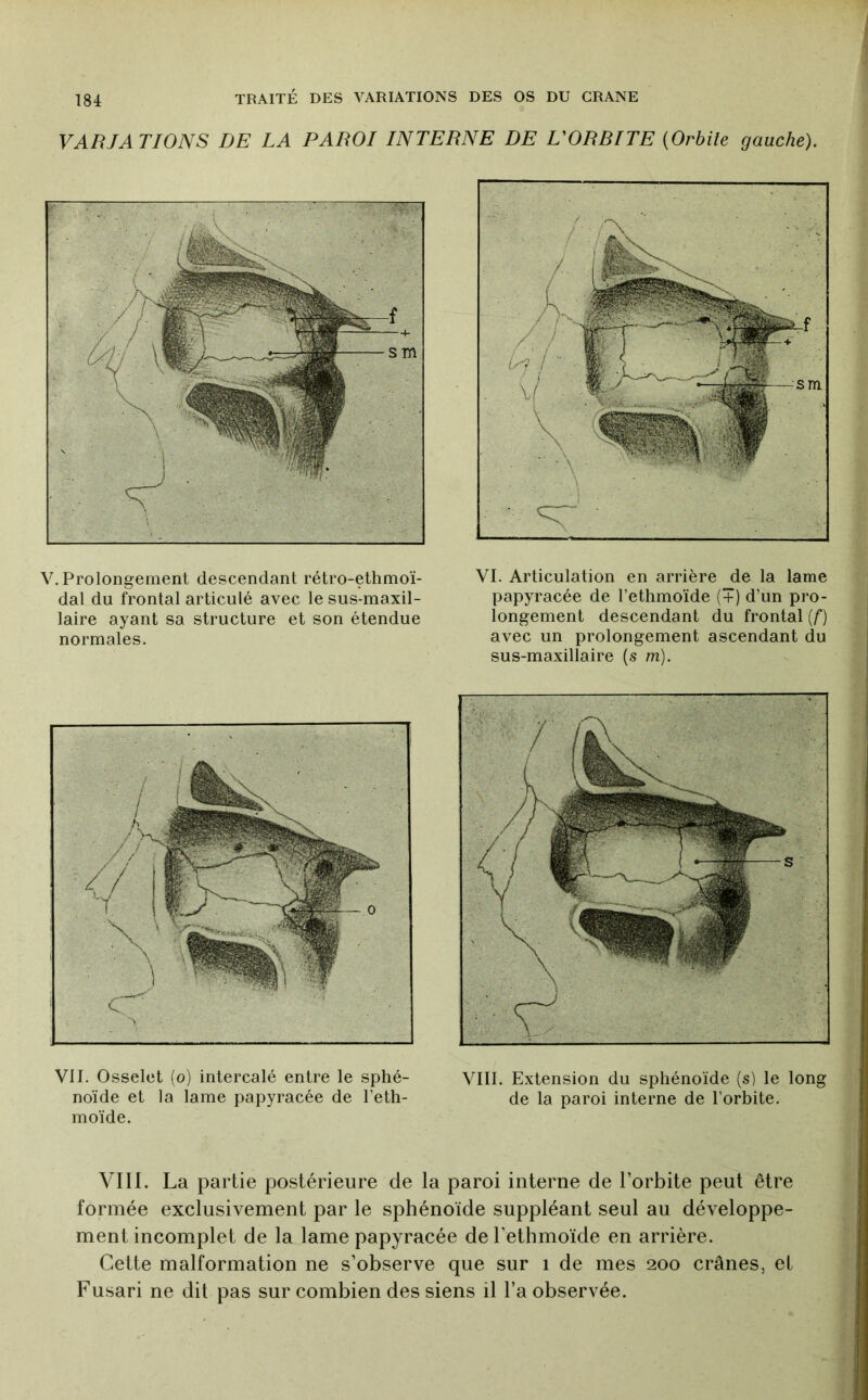 VARIATIONS DE LA PAROI INTERNE DE UORRITE {Orbite gauche). V, Prolongement descendant rétro-ethmoï- dal du frontal articulé avec le sus-maxil- laire ayant sa structure et son étendue normales. VI. Articulation en arrière de la lame papyracée de l’etlimoïde (+) d’un pro- longement descendant du frontal {f) avec un prolongement ascendant du sus-maxillaire (s m). VII. Osselet (o) intercalé entre le sphé- VIII. Extension du sphénoïde (s) le long noïde et la lame papyracée de l’eth- de la paroi interne de l’orbite, moïde. VIII. La partie postérieure de la paroi interne de l’orbite peut être formée exclusivement par le sphénoïde suppléant seul au développe- ment incomplet de la lame papyracée deTethmoide en arrière. Cette malformation ne s’observe que sur i de mes 200 crânes, et Fusari ne dit pas sur combien des siens il l’a observée.