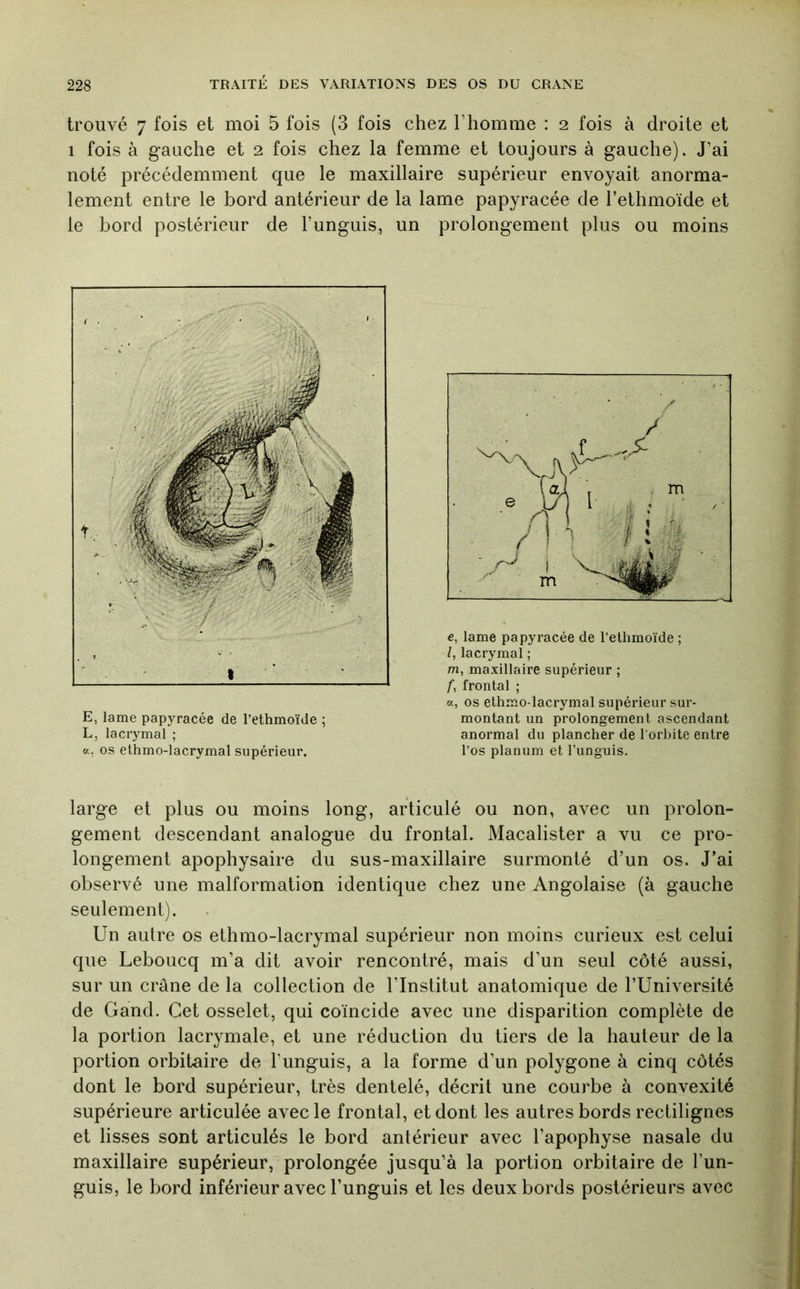trouvé 7 fois et moi 5 fois (3 fois chez l’homme : 2 fois à droite et 1 fois à gauche et 2 fois chez la femme et toujours à gauche). J’ai noté précédemment que le maxillaire supérieur envoyait anorma- lement entre le bord antérieur de la lame papyracée de l’ethmoïde et le bord postérieur de l’unguis, un prolongement plus ou moins t E, lame papyracée de l’ethmoïde ; L, lacrymal ; a, os ethmo-lacrymal supérieur. e, lame papyracée de l’elhmoïde ; /, lacrymal ; m, maxillaire supérieur ; f, frontal ; a, os ethmo-lacrymal supérieur sur- montant un prolongement ascendant anormal du plancher de l’orbite entre l’os planum et l’unguis. large et plus ou moins long, articulé ou non, avec un prolon- gement descendant analogue du frontal. Macalister a vu ce pro- longement apophysaire du sus-maxillaire surmonté d’un os. J’ai observé une malformation identique chez une Angolaise (à gauche seulement). Un autre os ethmo-lacrymal supérieur non moins curieux est celui que Leboucq m’a dit avoir rencontré, mais d’un seul côté aussi, sur un crâne de la collection de l’Institut anatomique de TUniversité de Gand. Cet osselet, qui coïncide avec une disparition complète de la portion lacrymale, et une réduction du tiers de la hauteur de la portion orbitaire de l’unguis, a la forme d’un polygone à cinq côtés dont le bord supérieur, très dentelé, décrit une courbe à convexité supérieure articulée avec le frontal, et dont les autres bords rectilignes et lisses sont articulés le bord antérieur avec l’apophyse nasale du maxillaire supérieur, prolongée jusqu’à la portion orbitaire de l’un- guis, le bord inférieur avec l’unguis et les deux bords postérieurs avec