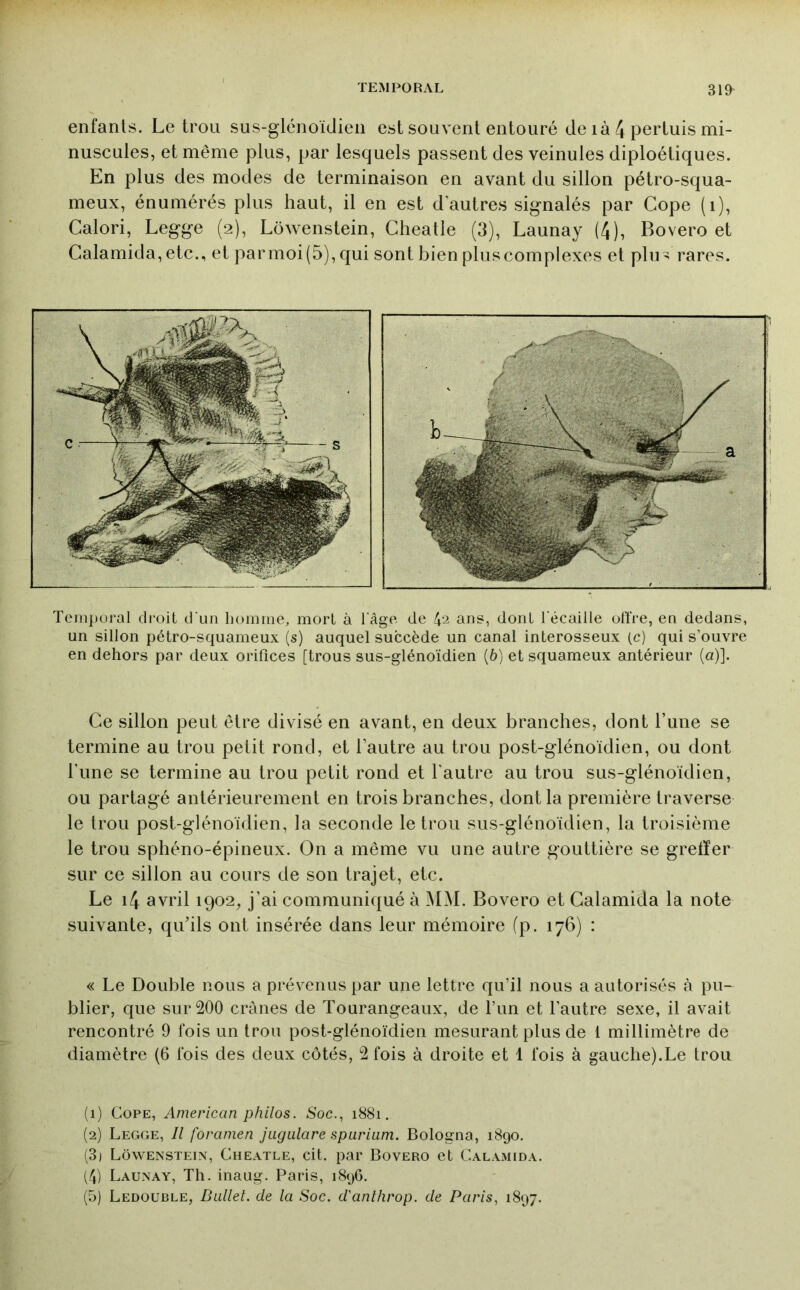 enfants. Le trou sus-glénoidien est souvent entouré de i à 4 pertuis mi- nuscules, et même plus, par lesquels passent des veinules diploétiques. En plus des modes de terminaison en avant du sillon pétro-squa- meux, énumérés plus haut, il en est d'autres signalés par Cope (i), Calori, Legge (2), Lôwenstein, Gheatle (3), Launay (4), Bovero et Calamida,etc., et parmoi(5), qui sont bien plus complexes et plu - rares. Temporal di'oit d‘un homme, mort à l'Age de 4^ ans, dont récaille offre, ea dedans, un sillon pétro-squameux (s) auquel succède un canal interosseux (c) qui s’ouvre en dehors par deux orifices [trous sus-gléno'idien (6) et squameux antérieur (a)]. Ce sillon peut être divisé en avant, en deux branches, dont l’une se termine au trou petit rond, et l’autre au trou post-glénoidien, ou dont l’une se termine au trou petit rond et l’autre au trou sus-glénoïdien, ou partagé antérieurement en trois branches, dont la première traverse le trou post-gléno'idien, la seconde le trou sus-gléno'idien, la troisième le trou sphéno-épineux. On a même vu une autre gouttière se greffer sur ce sillon au cours de son trajet, etc. Le i4 avril 1902, j’ai communiqué à MM. Bovero et Calamida la note suivante, qu’ils ont insérée dans leur mémoire fp. 176) : « Le Double nous a prévenus par une lettre qu’il nous a autorisés h pu- blier, que sur 200 crânes de Tourangeaux, de l’im et l’autre sexe, il avait rencontré 9 fois un trou post-gléno'idien mesurant plus de 1 millimètre de diamètre (6 fois des deux côtés, 2 fois à droite et 1 fois à gauche).Le trou (1) Cope, American philos. Soc.., 1881. (2) Legge, Il foramen jugulare spurium. Bologna, 1890. (3) Lôwenstein, Gheatle, cit. par Bovero et Calamida. (4) Launay, Th. inaug. Paris, 1896.