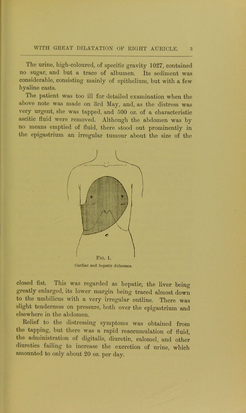 The urine, high-coloured, of specific gravity 1027, contained no sugar, and but a trace of albumen. Its sediment was considerable, consisting mainly of epithelium, but with a few hyaline casts. The patient was too ill for detailed examination when the above note was made on 3rd May, and, as tbe distress was very urgent, she was tapped, and 500 oz. of a characteristic ascitic fluid were removed. Although the abdomen was by no means emptied of fluid, there stood out prominently in the epigastrium an irregular tumour about the size of the closed fist. This was regarded as hepatic, the liver being greatly enlarged, its lower margin being traced almost down to the umbilicus with a very irregular outline. There was slight tenderness on pressure, both over the epigastrium and elsewhere in the abdomen. Relief to the distressing symptoms was obtained from the tapping, but there was a rapid reaccumulation of fluid, the administration of digitalis, diuretin, calomel, and other cs failin0 to increase the excretion of urine, which amounted to only about 20 oz. per day.