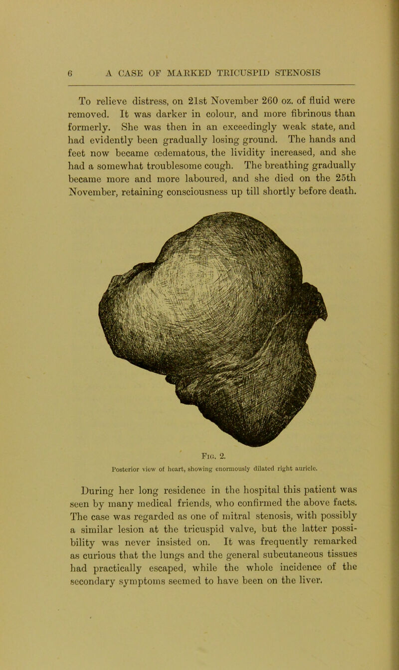 To relieve distress, on 21st November 260 oz. of fluid were removed. It was darker in colour, and more fibrinous than formerly. She was then in an exceedingly weak state, and had evidently been gradually losing ground. The hands and feet now became cedematous, the lividity increased, and she had a somewhat troublesome cough. The breathing gradually became more and more laboured, and she died on the 25th November, retaining consciousness up till shortly before death. Fig. 2. Posterior view of heart, showing enormously dilated right auricle. During her long residence in the hospital this patient was seen by many medical friends, who confirmed the above facts. The case was regarded as one of mitral stenosis, with possibly a similar lesion at the tricuspid valve, but the latter possi- bility was never insisted on. It was frequently remarked as curious that the lungs and the general subcutaneous tissues had practically escaped, while the whole incidence of the secondary symptoms seemed to have been on the liver.