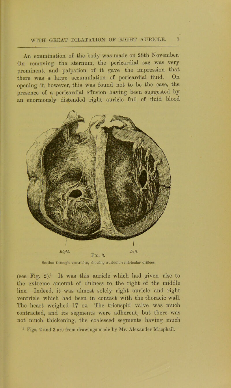 An examination of the body was made on 28th November. On removing the sternum, the pericardial sac was very prominent, and palpation of it gave the impression that there was a large accumulation of pericardial fluid. On opening it, however, this was found not to be the case, the presence of a pericardial effusion having been suggested by an enormously distended right auricle full of fluid blood (see Fig. 2).1 It was this auricle which had given rise to the extreme amount of dulness to the right of the middle line. Indeed, it was almost solely right auricle and right ventricle which had been in contact with the thoracic wall. The heart weighed 17 oz. The tricuspid valve was much contracted, and its segments were adherent, but there was not much thickening, the coalesced segments having much 1 Figs. 2 and 3 are from drawings made by Mr. Alexander Macphail. Right. Left. Fig. 3. Section through ventricles, showing auriculo-ventricular orifices.